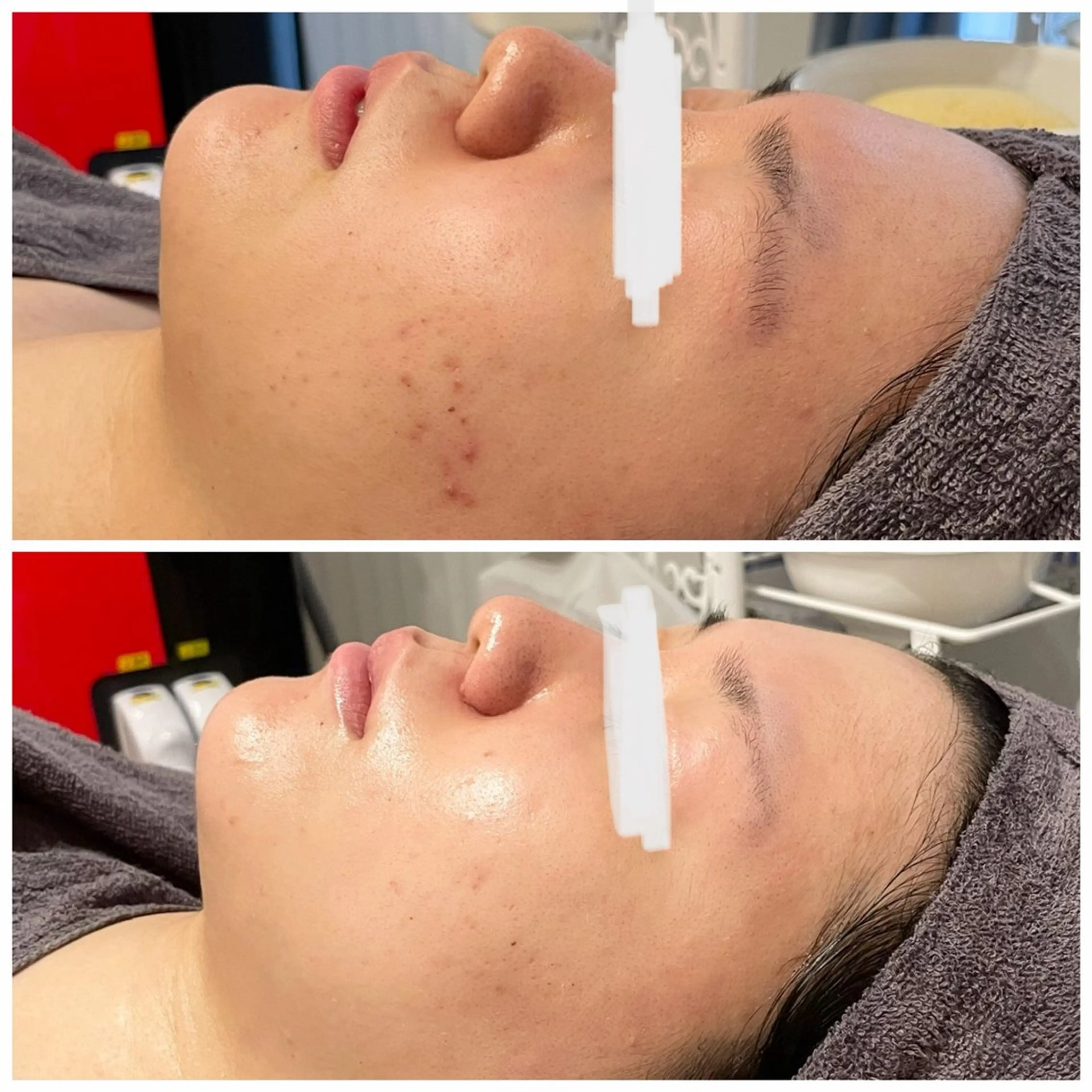 毛穴改善ハーブピーリングMinouミヌ心斎橋所属・ミヌ心斎橋 あやめのエステ・リラクイメージ