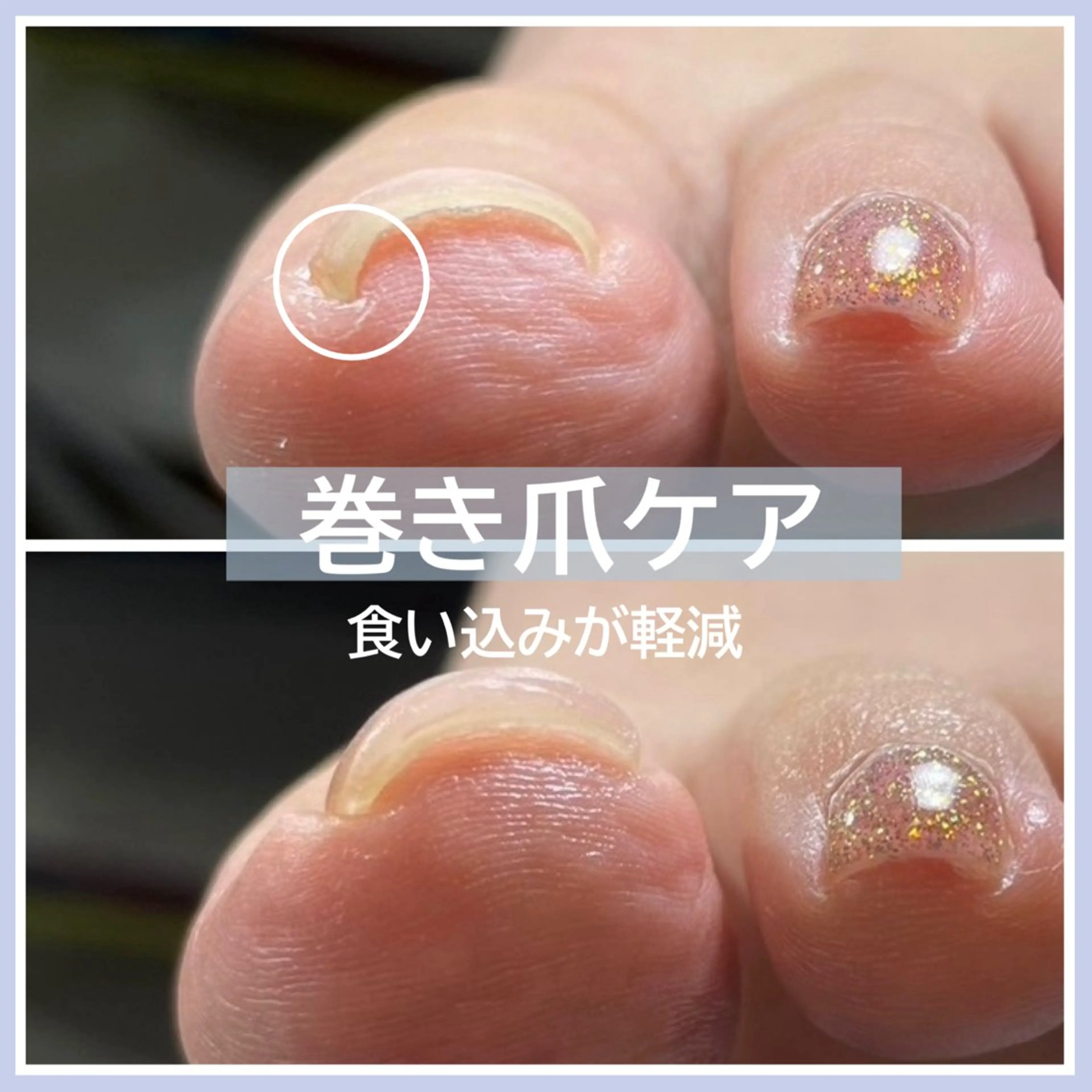 ネイル ハンドネイル フットネイル 巻き爪補正 Umber　Miyaのネイルデザイン