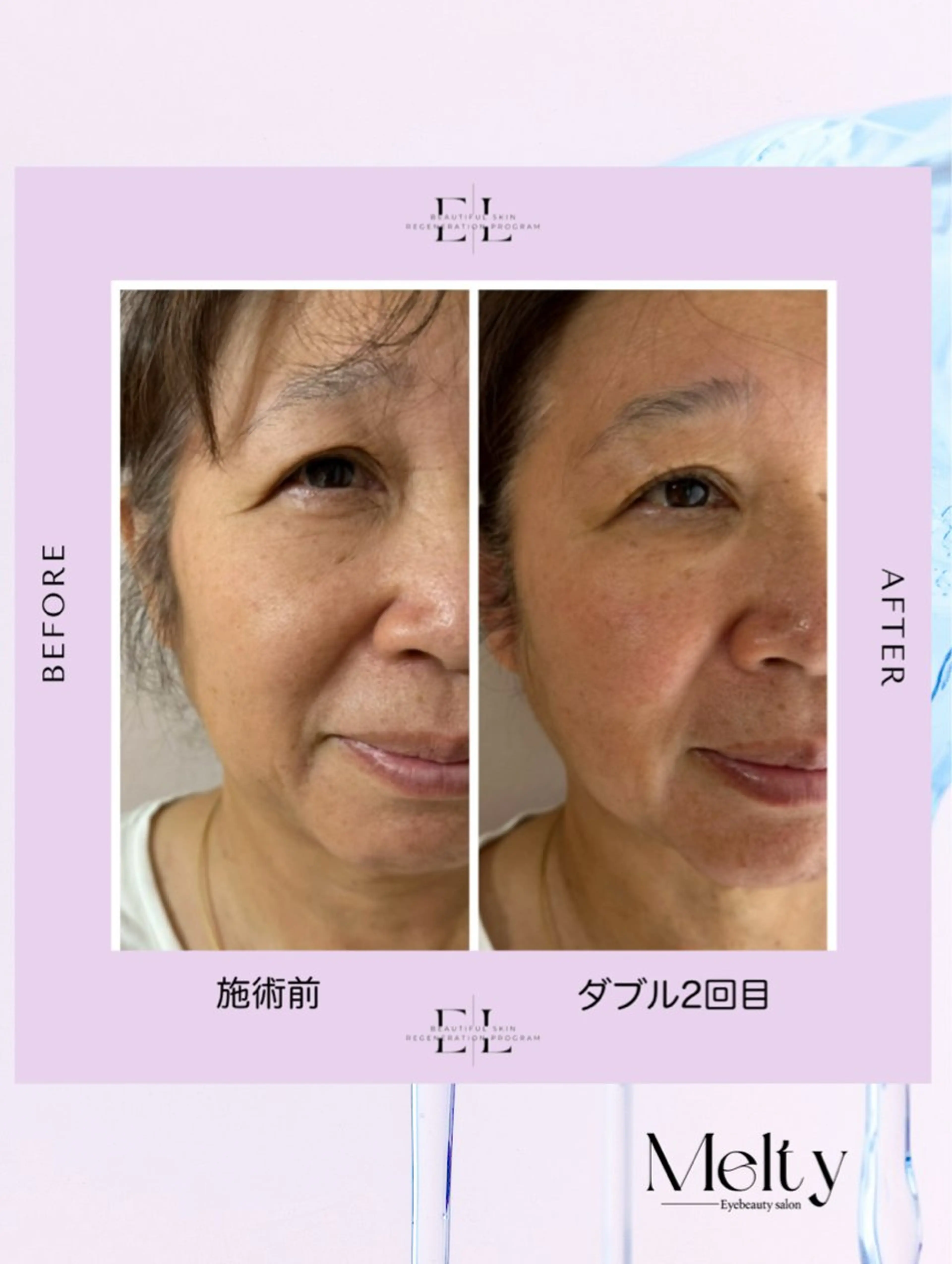 肌再生プログラム【ExoLift】の写真