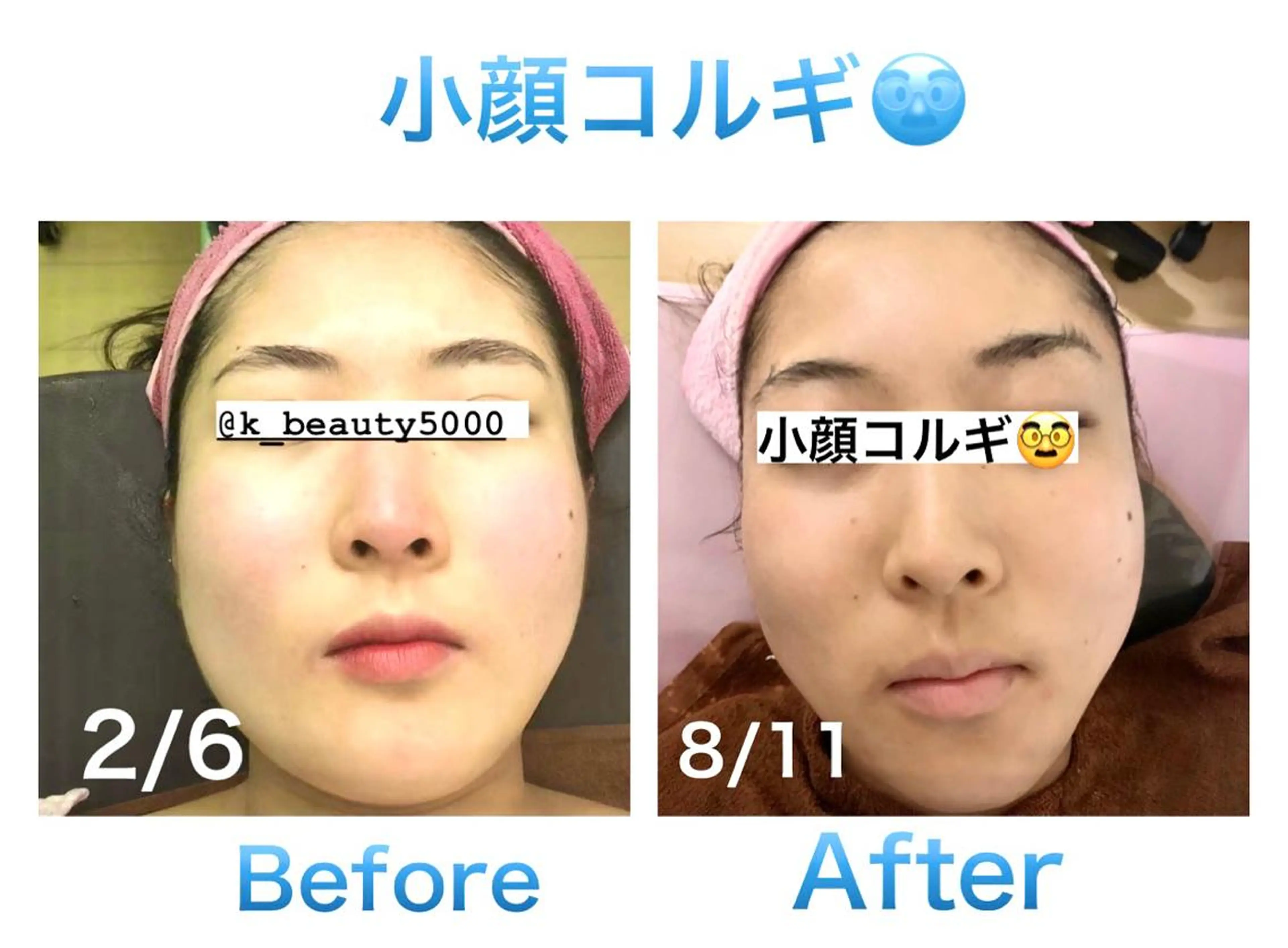 【ハイパーナイフ痩身&小顔コルギ&ハーブピーリング】K-Beauty　東新宿所属・kーbeauty小顔 コルギ&インディバのエステ・リラクイメージ