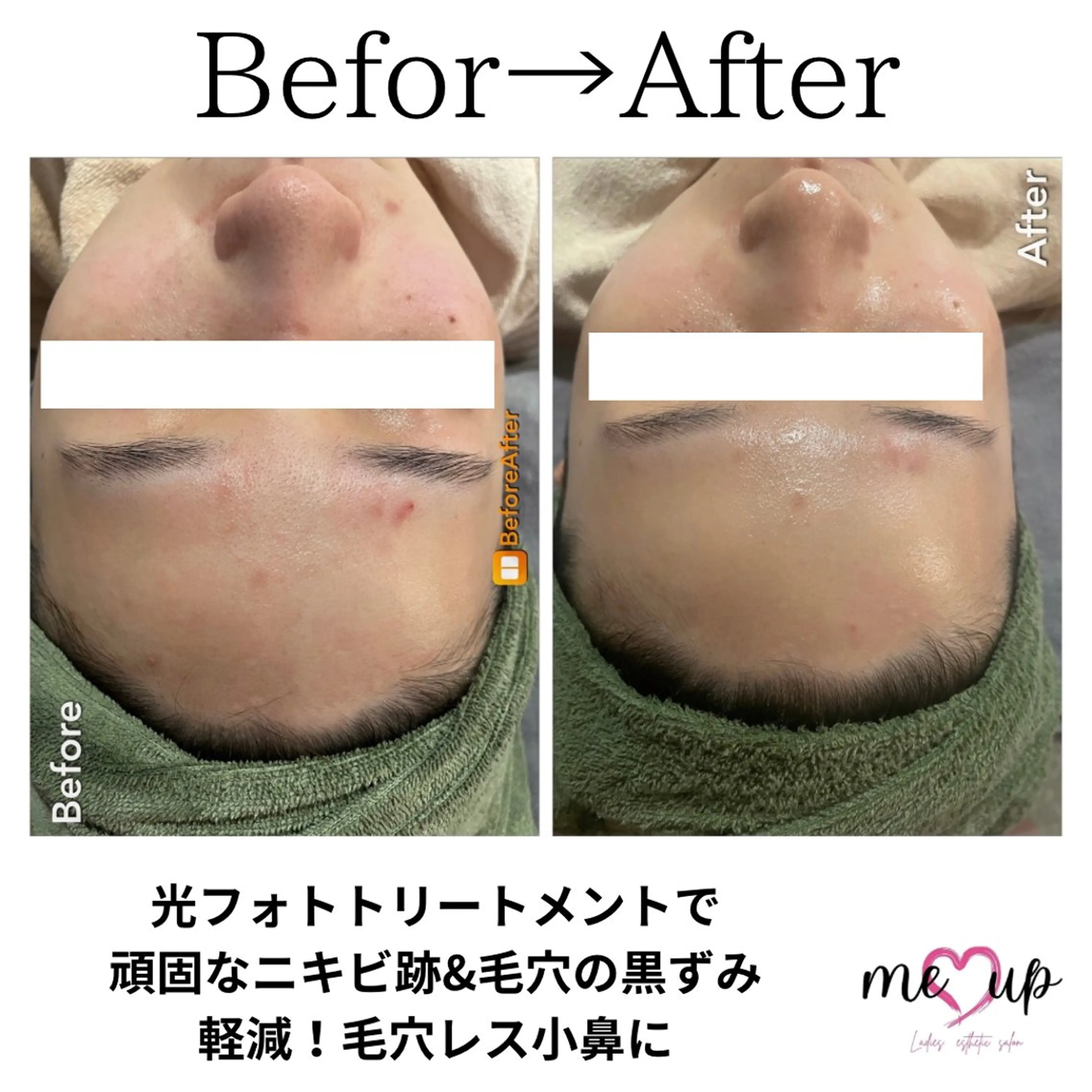 エステ Meupニキビ専門店 背中/ハーブ/ララのその他イメージ