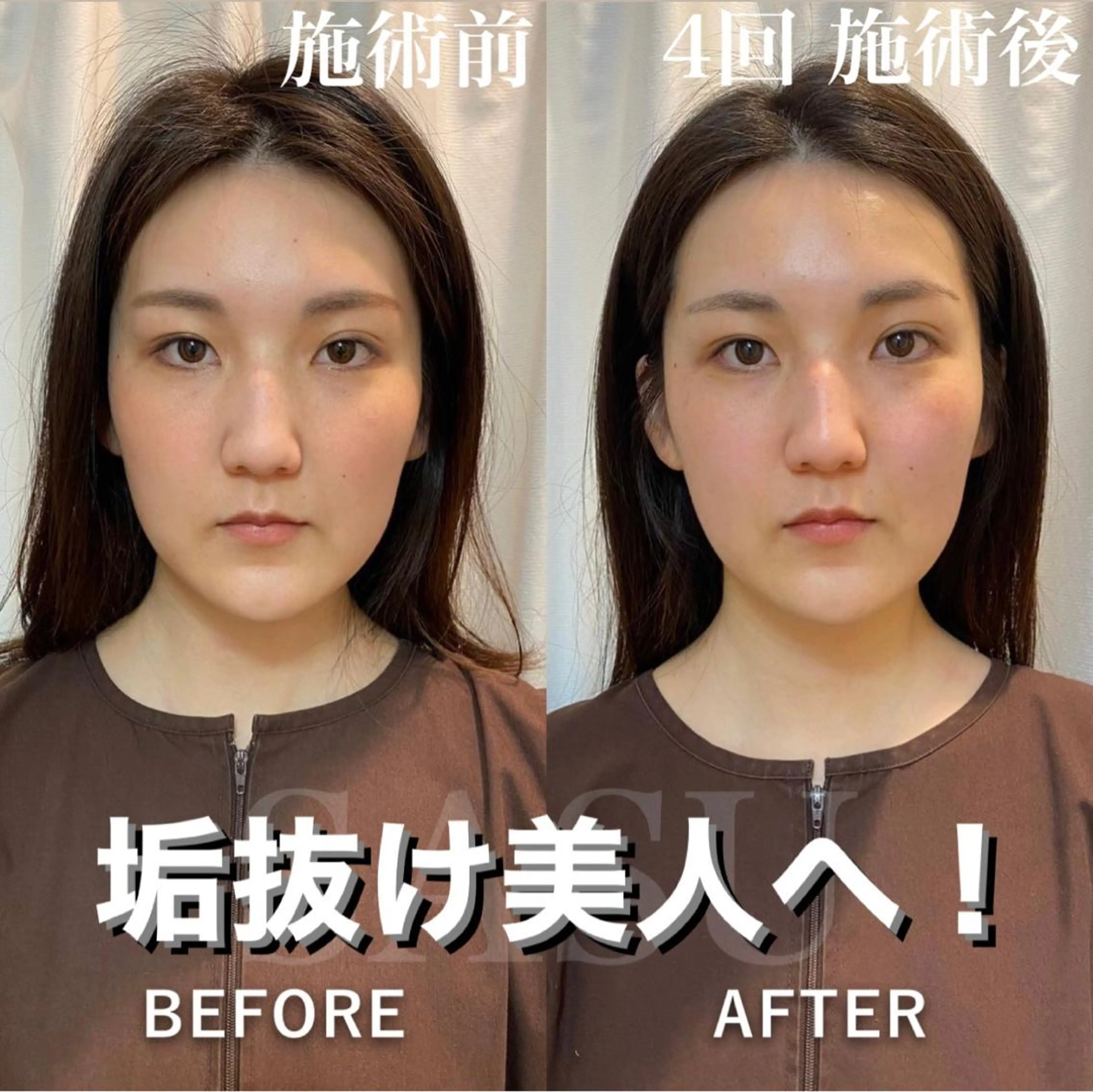 ロング カラー パーマ ヘアアレンジ メンズ キッズ ネイル マツエク・マツパ アイブロウ 透明感カラー その他 即小顔♥️美容鍼× ハーブピーリングのその他イメージ