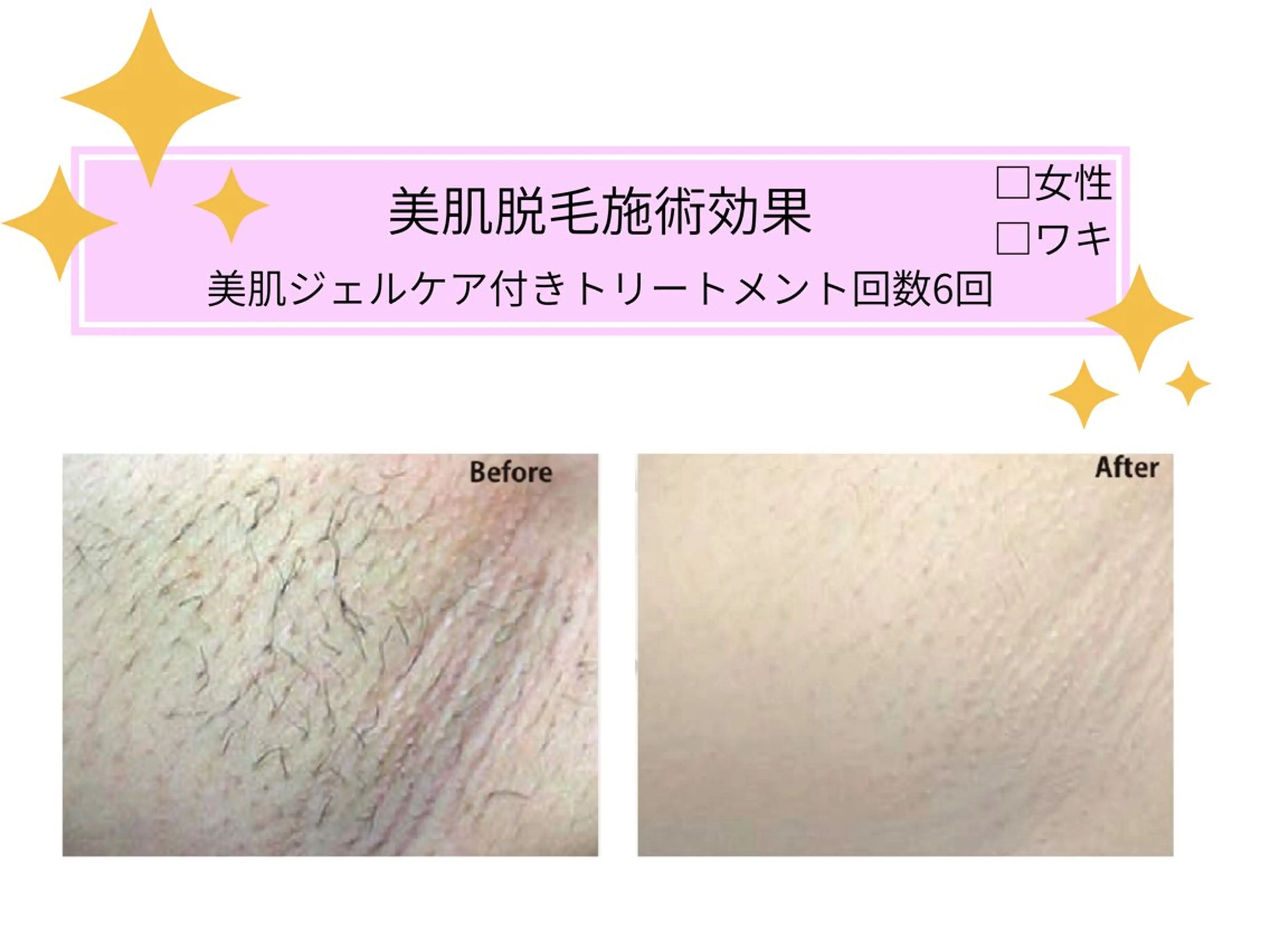 脱毛 VIKI BEAUTY  クレイハーブピーリング・美肌脱毛専門店所属・VIKI BEAUTYのエステ・リラクイメージ