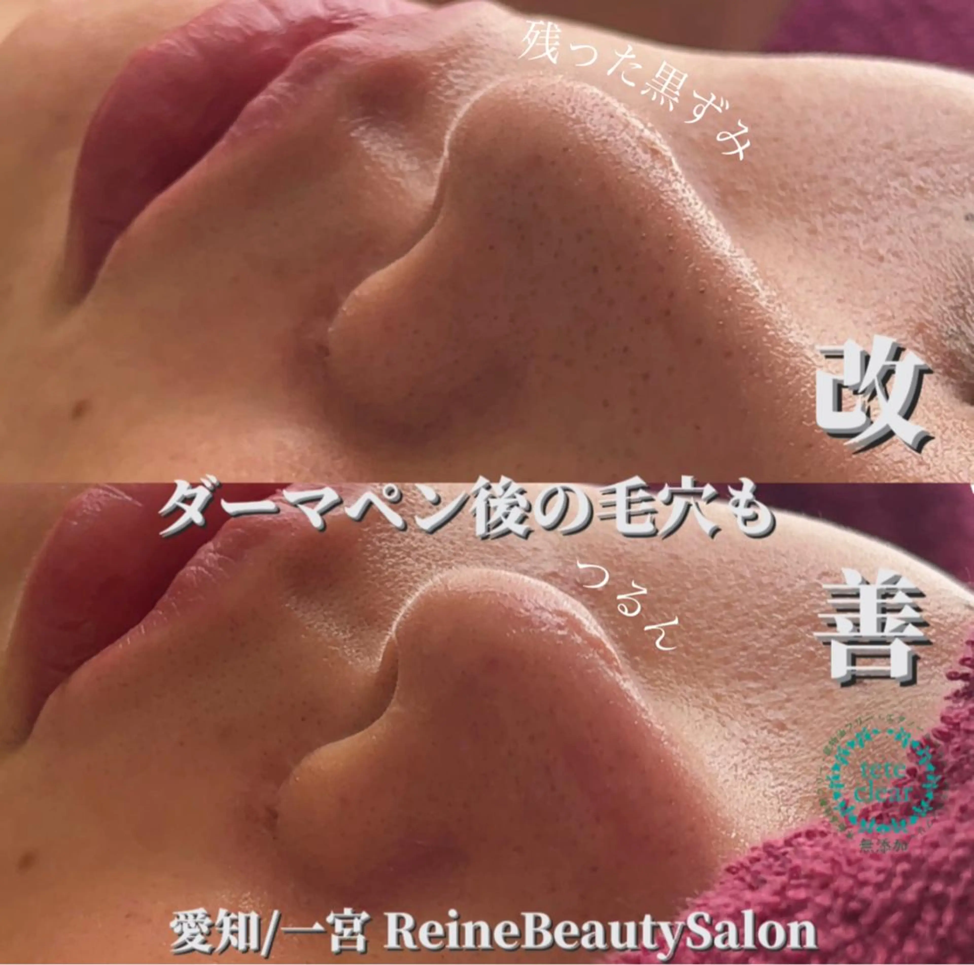 エステ Reine BeautySalon所属・毛穴/シミ肝斑/脱毛 横山梨里のエステ・リラクイメージ