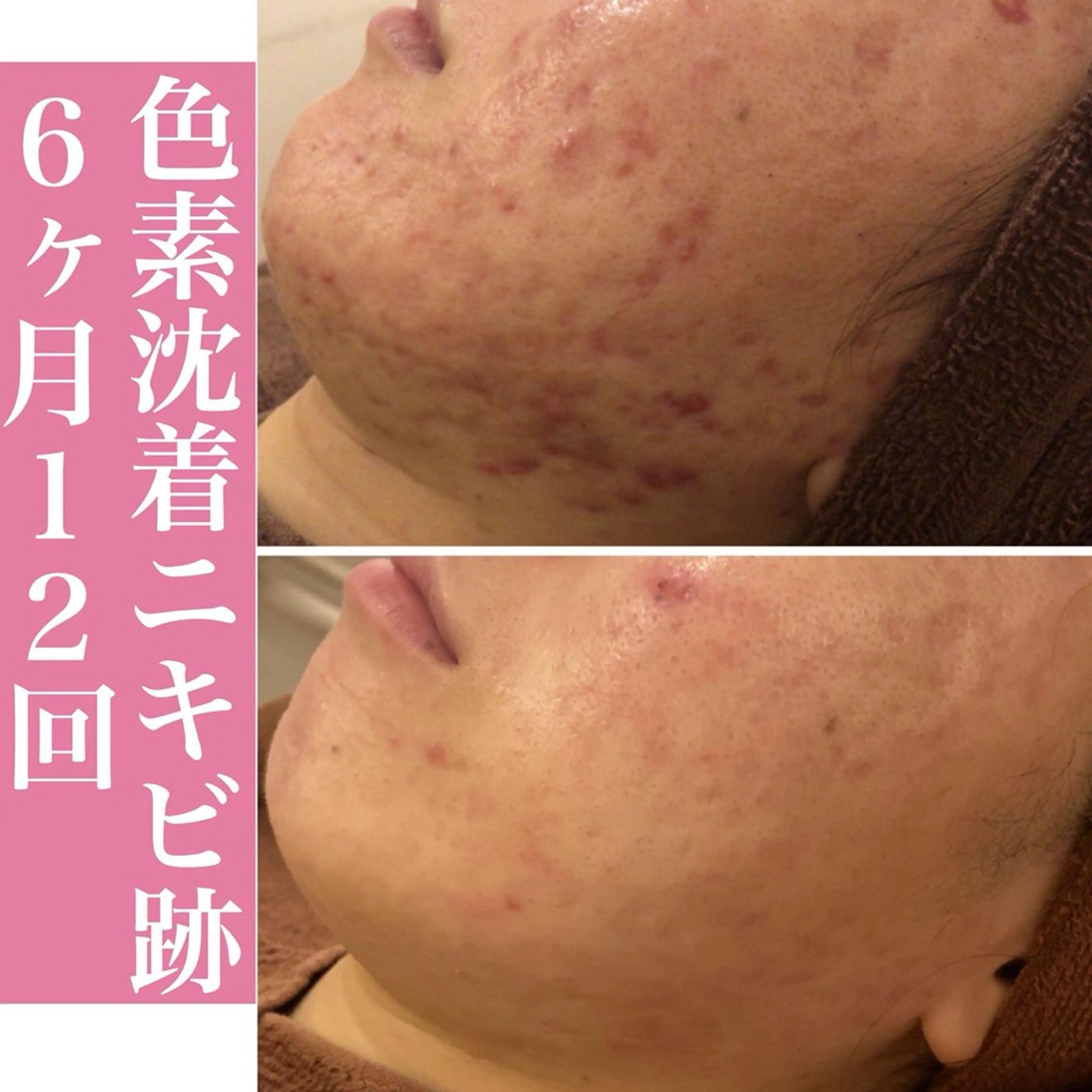 学生ニキビ改善🍀 優しい肌質改善のエステ・リラクイメージ