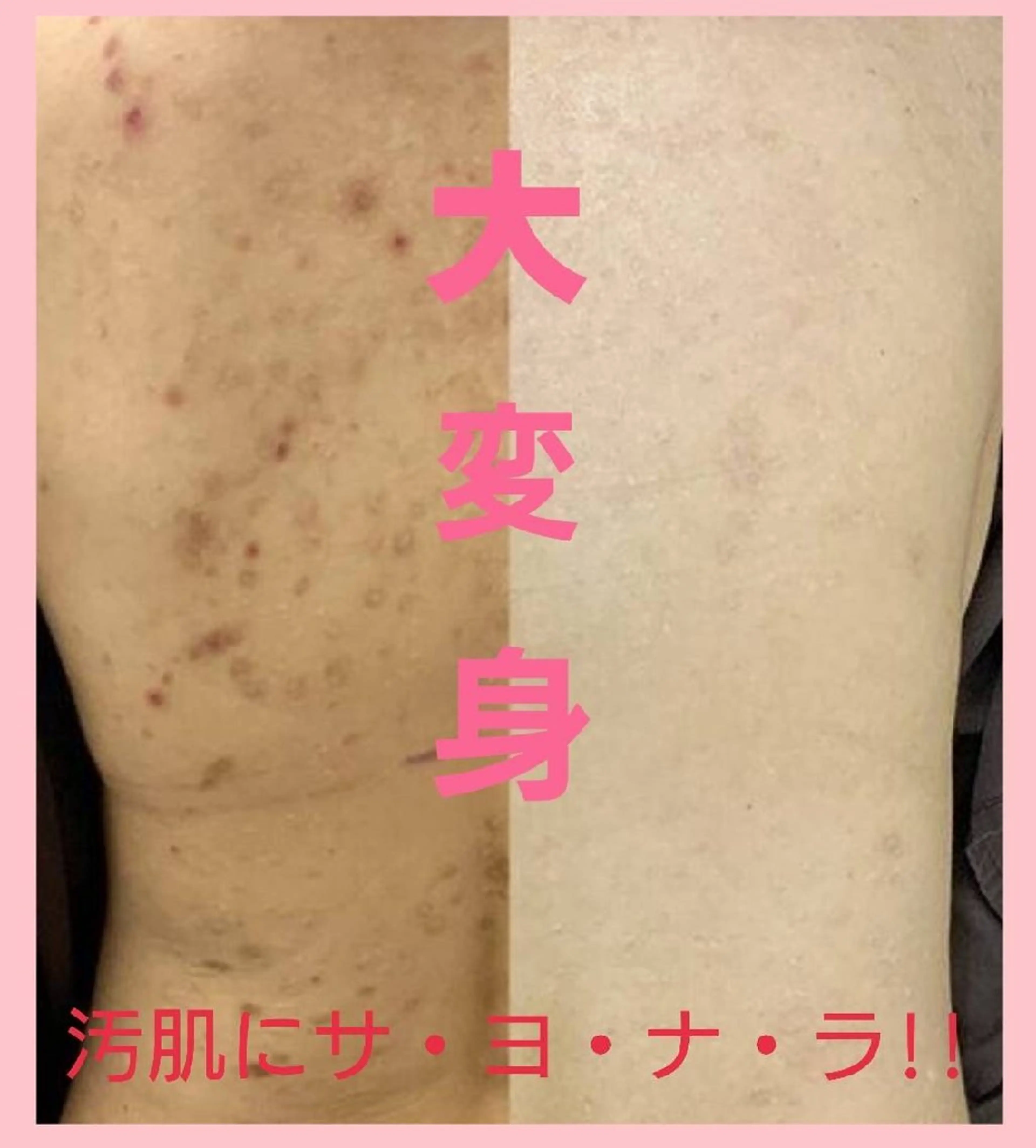 2倍増量ハードハーブピーリング🌿痛いけど効く‼️背中、お尻、二の腕に!鮫肌、毛孔性苔癬、しつこい色素沈着にオススメ🤩の写真