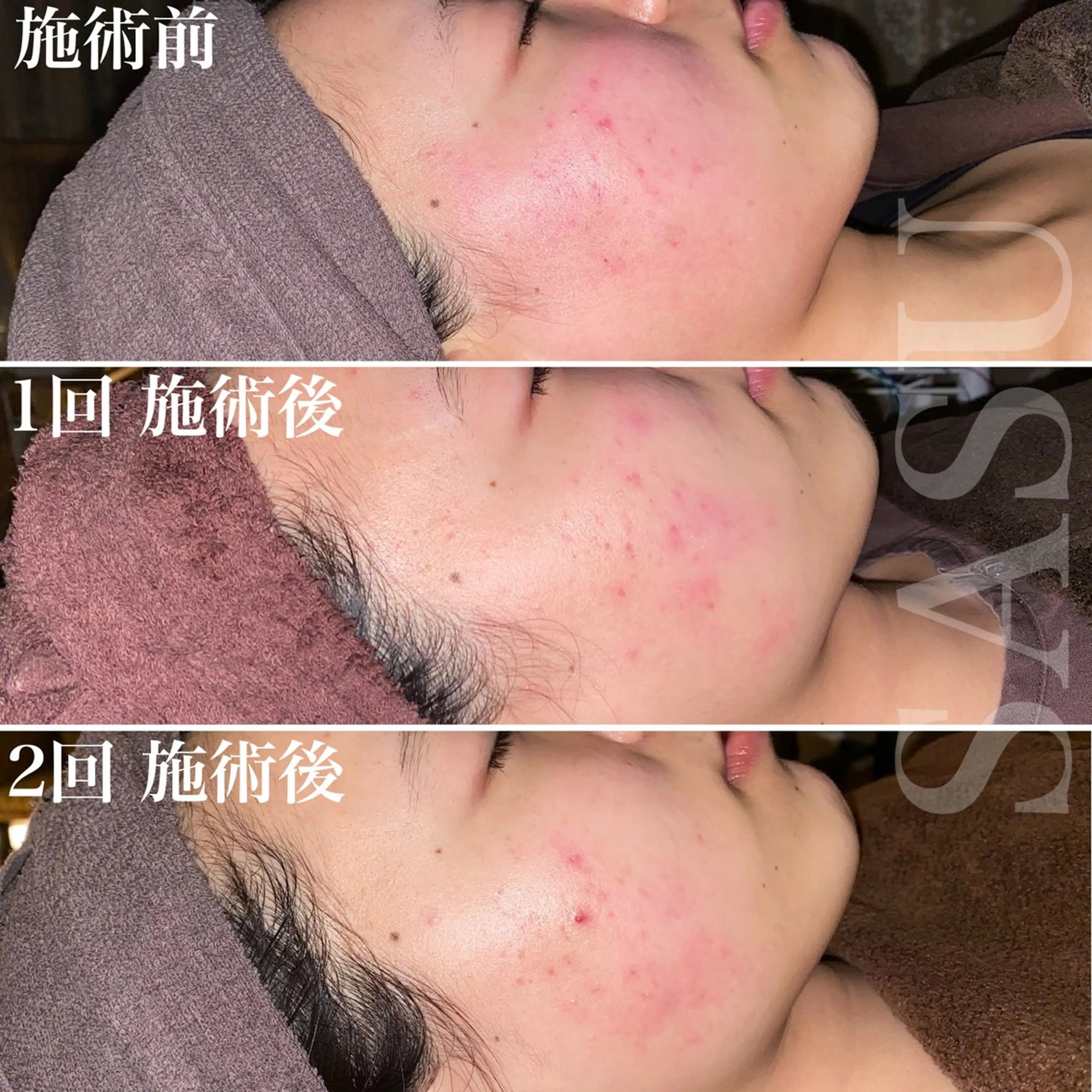 【ハーブピーリング🌿】シミ､そばかす､ニキビ跡､全部同時退治😊美容鍼or炭酸オプション各種¥1500で追加できますの写真