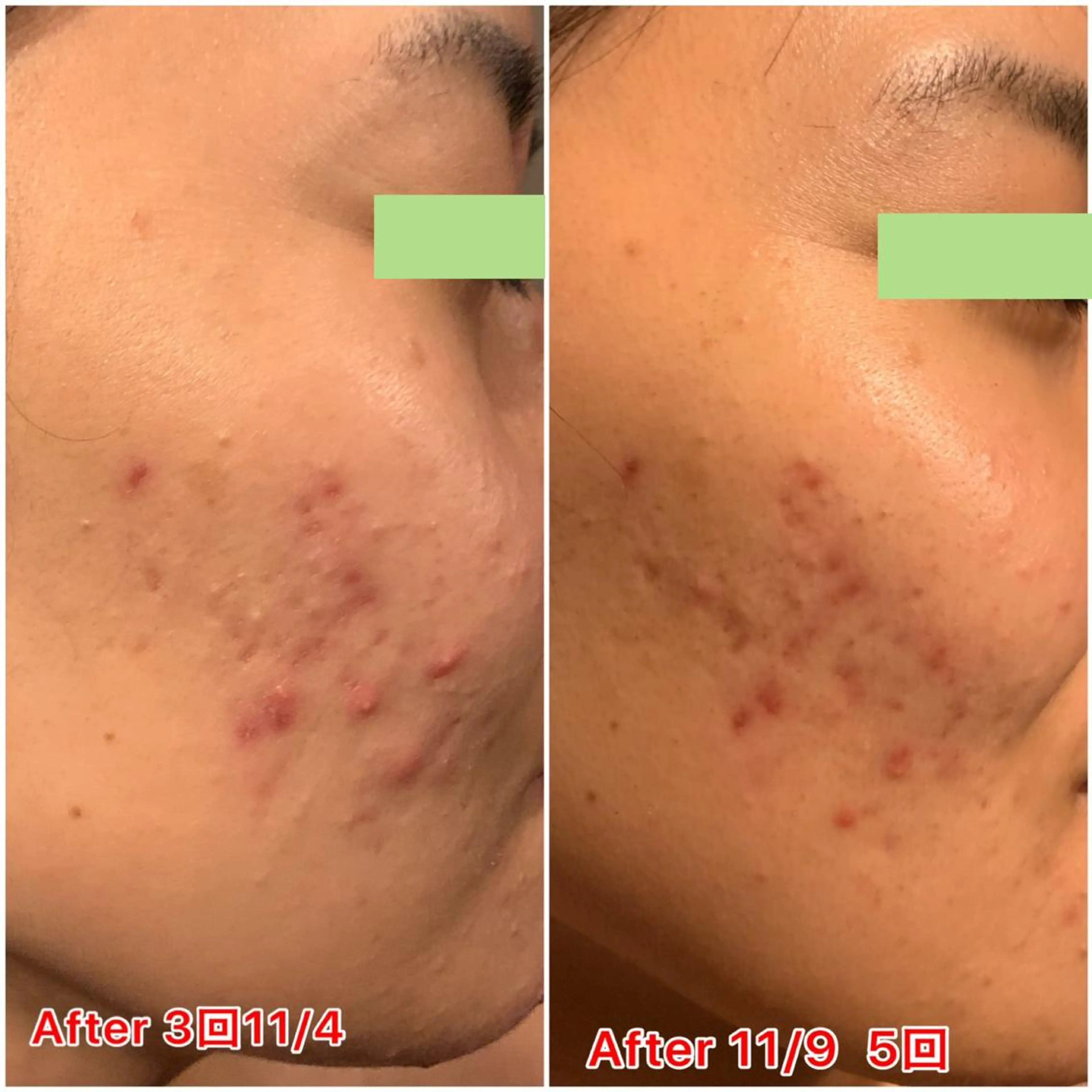 【ハイパーナイフ痩身&小顔コルギ&ハーブピーリング】K-Beauty　東新宿所属・kーbeauty痩身 フェイシャルのエステ・リラクイメージ