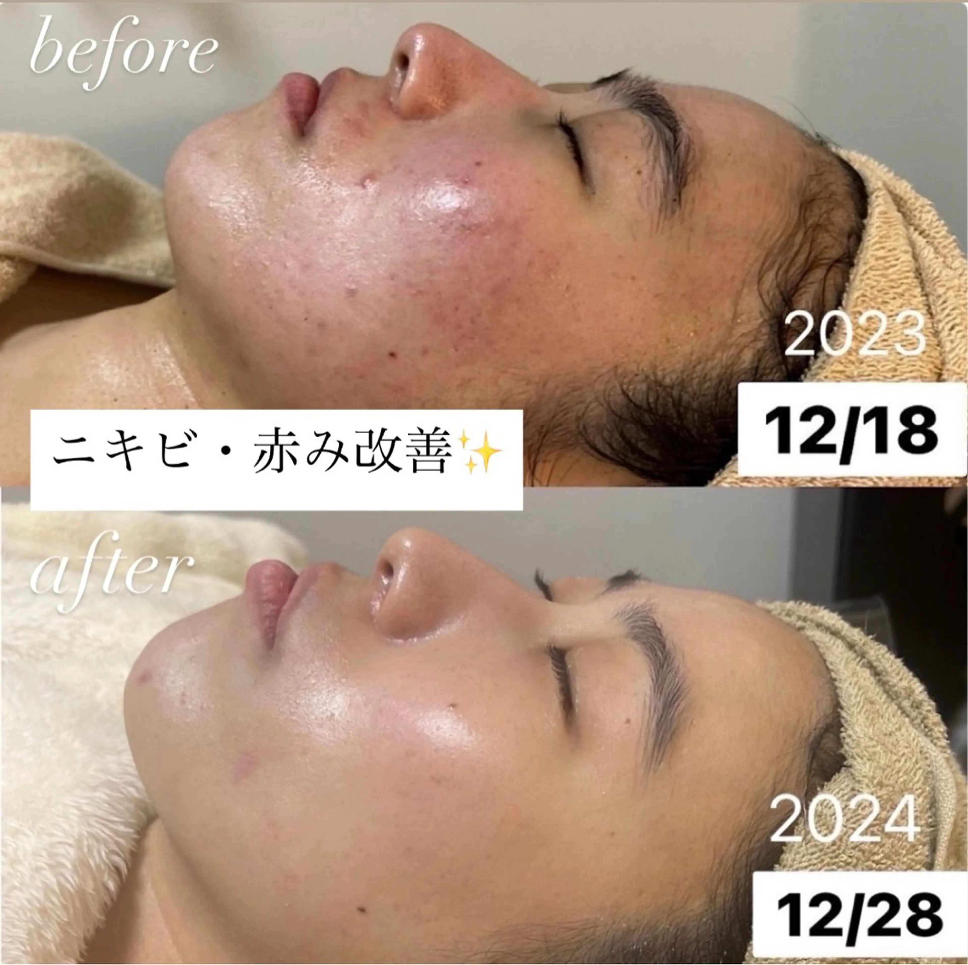 肌質改善専門サロンAte国分寺店所属・Ate Rikaのエステ・リラクイメージ