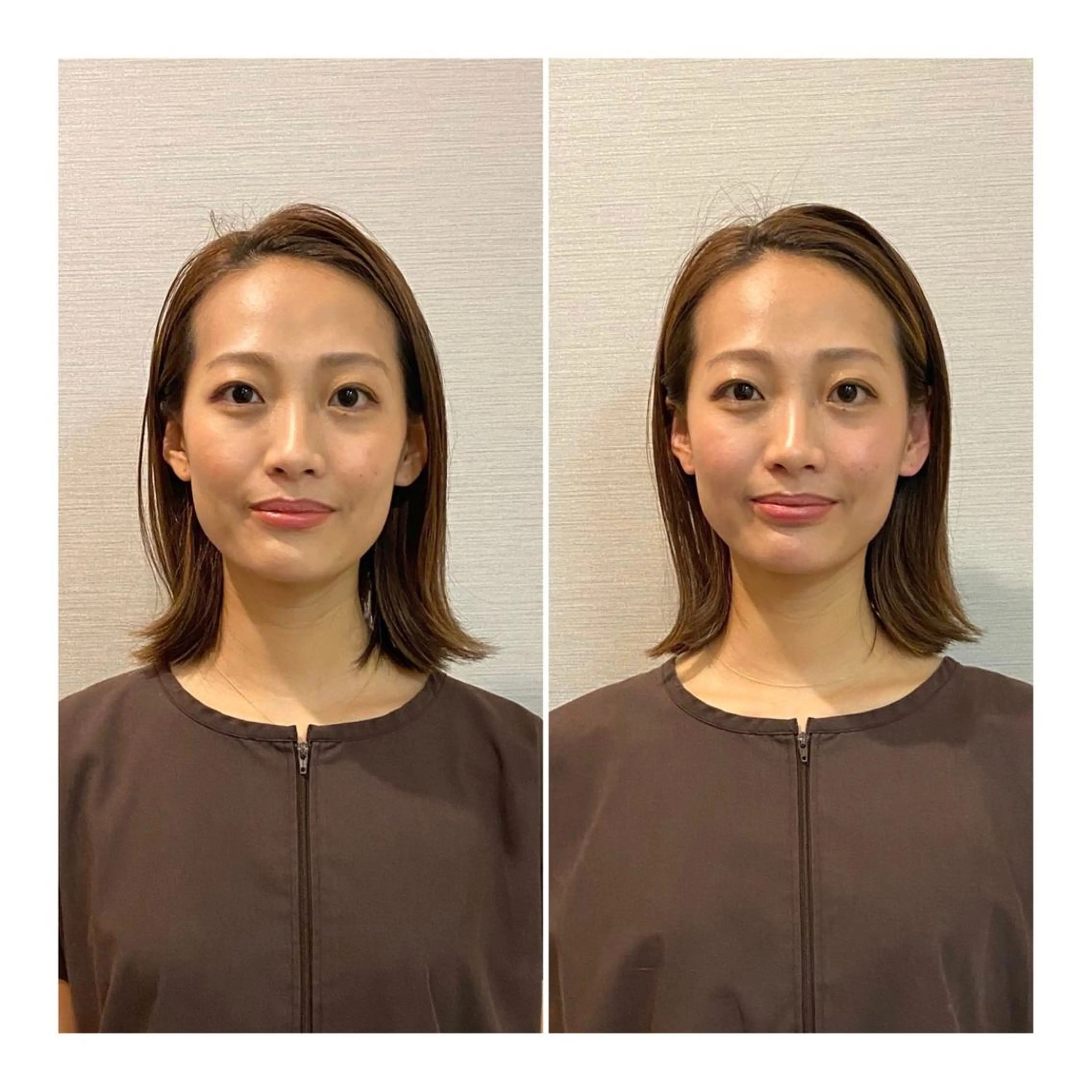 ミディアム 即小顔♥️美容鍼× ハーブピーリングのその他イメージ