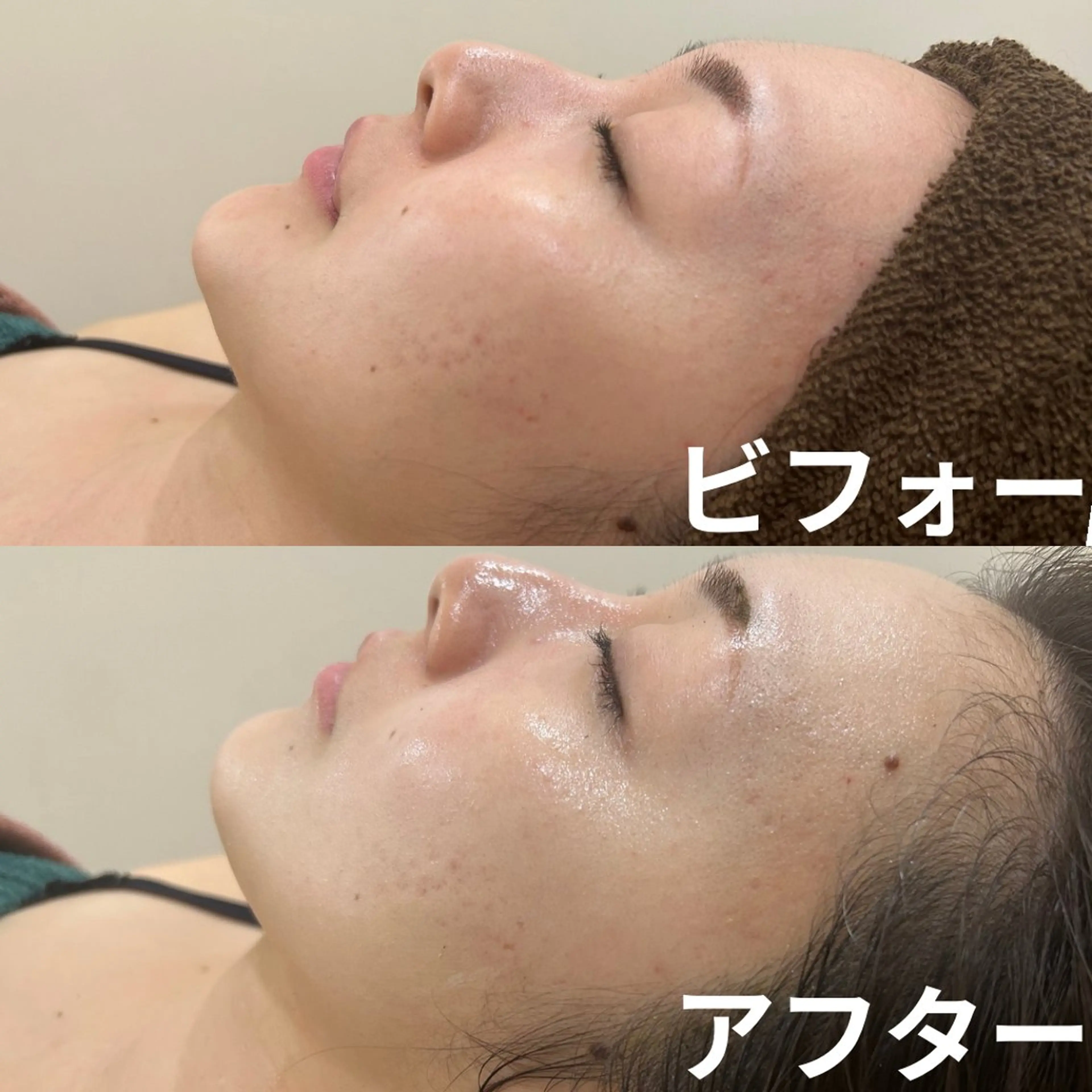 エステ NiU.BEAUTY🥥池袋店所属・ハーブピーリング専門 NiU.BEAUTYのエステ・リラクイメージ