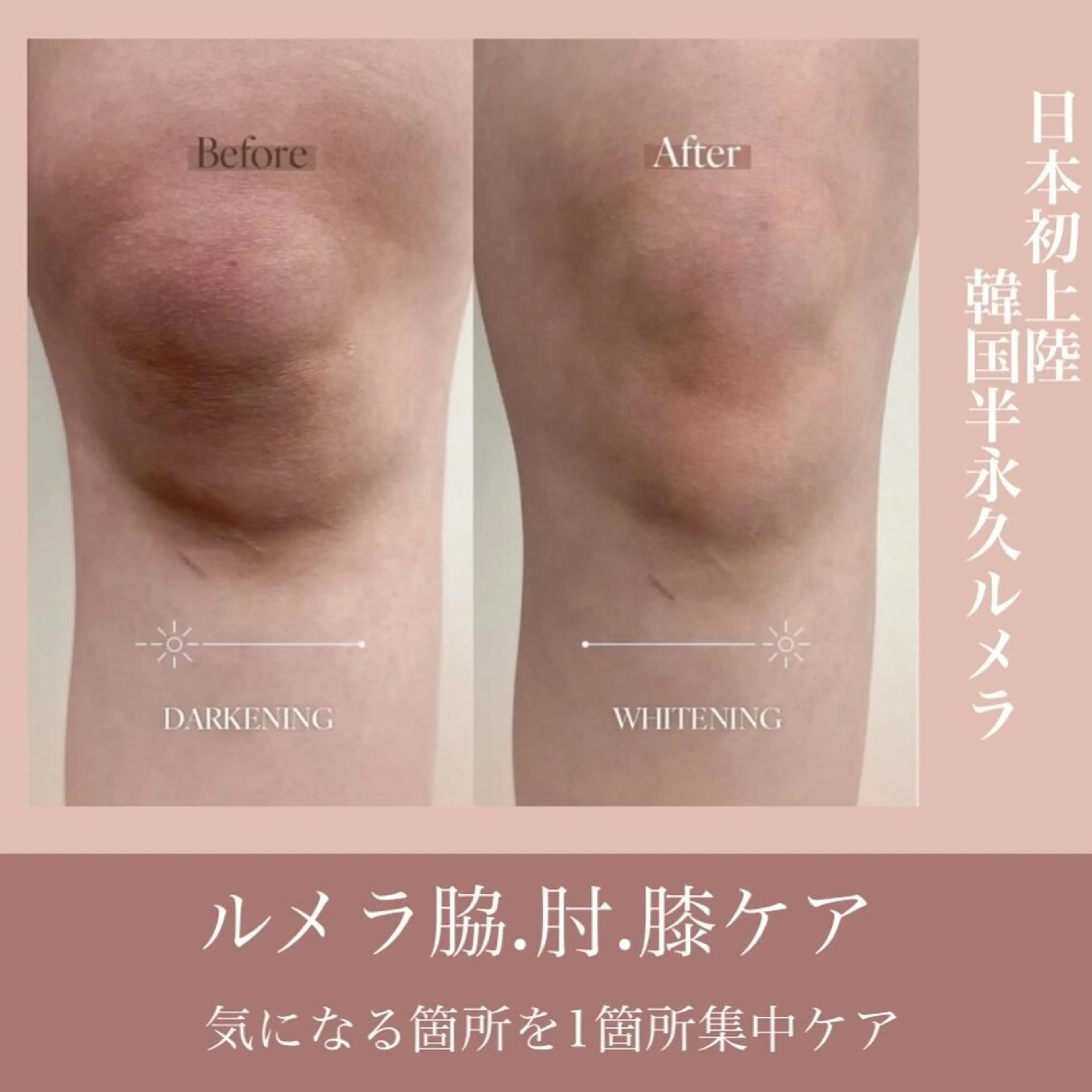 【ルメラ選べる1部位】ワキ/ひじ/ひざの黒ずみケアに ¥98000→¥57900の写真