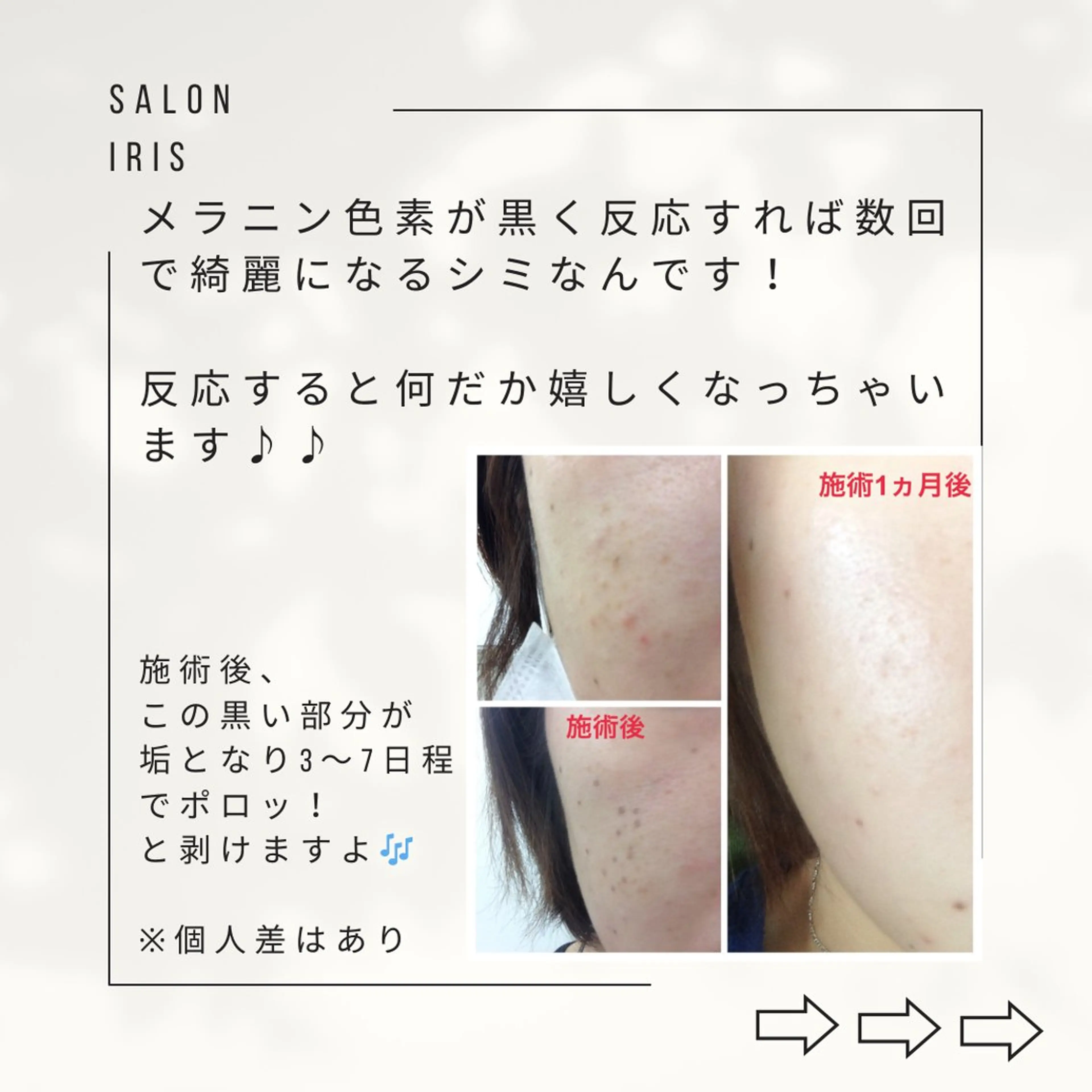 ■シミケアデトックス■低周波でシミを垢化させターンオーバーで排出させていきます✨の写真