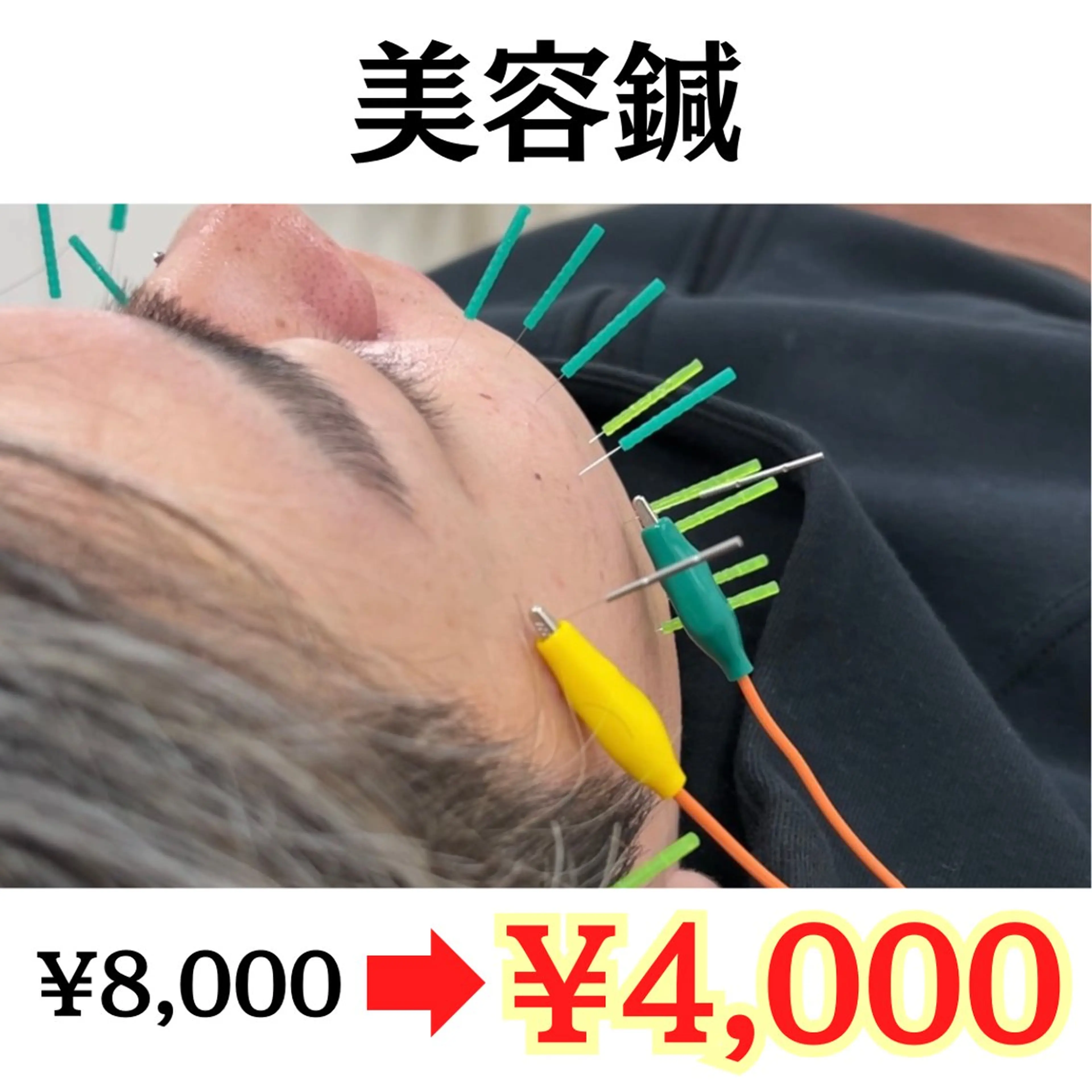 【新規クーポン】美容鍼(たるみ ほうれい線 リフトアップ)(60分)の写真