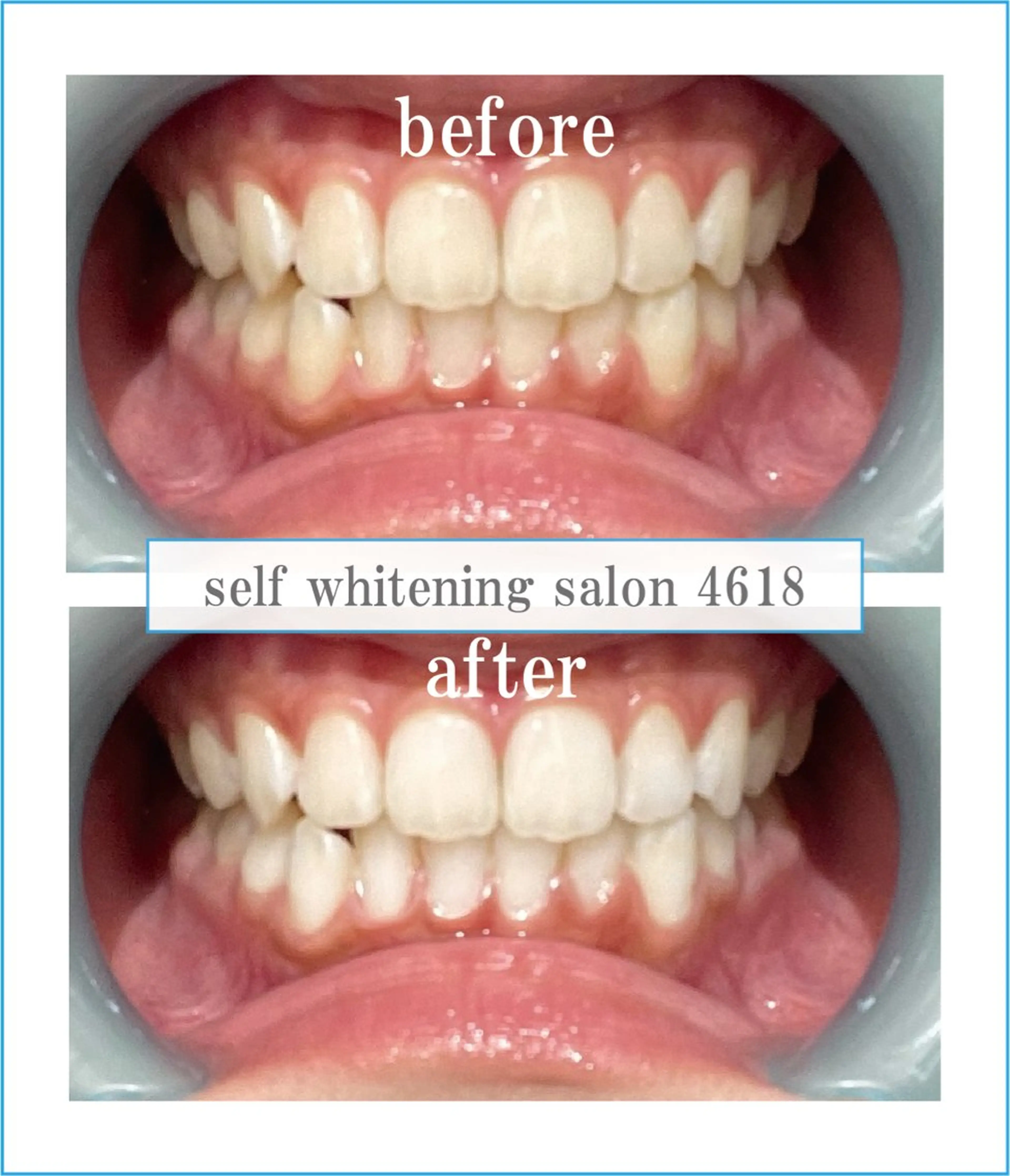 その他 self whitening salon 4618所属・ホワイトニングサロン 4618のその他イメージ