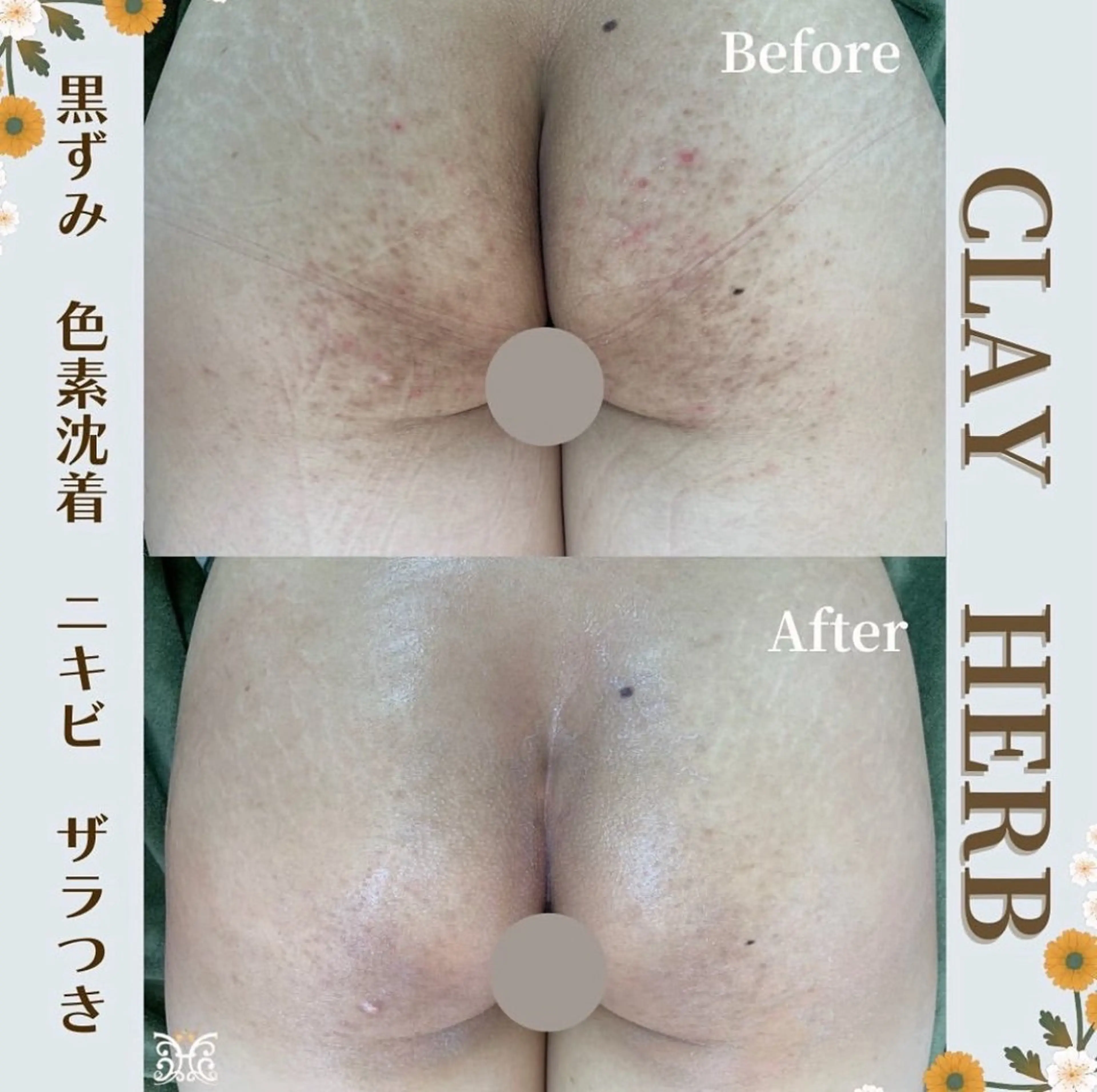 【剥離ありハーブピーリングBODY/レベル3】ヒップのざらつき黒ずみ集中プランの写真
