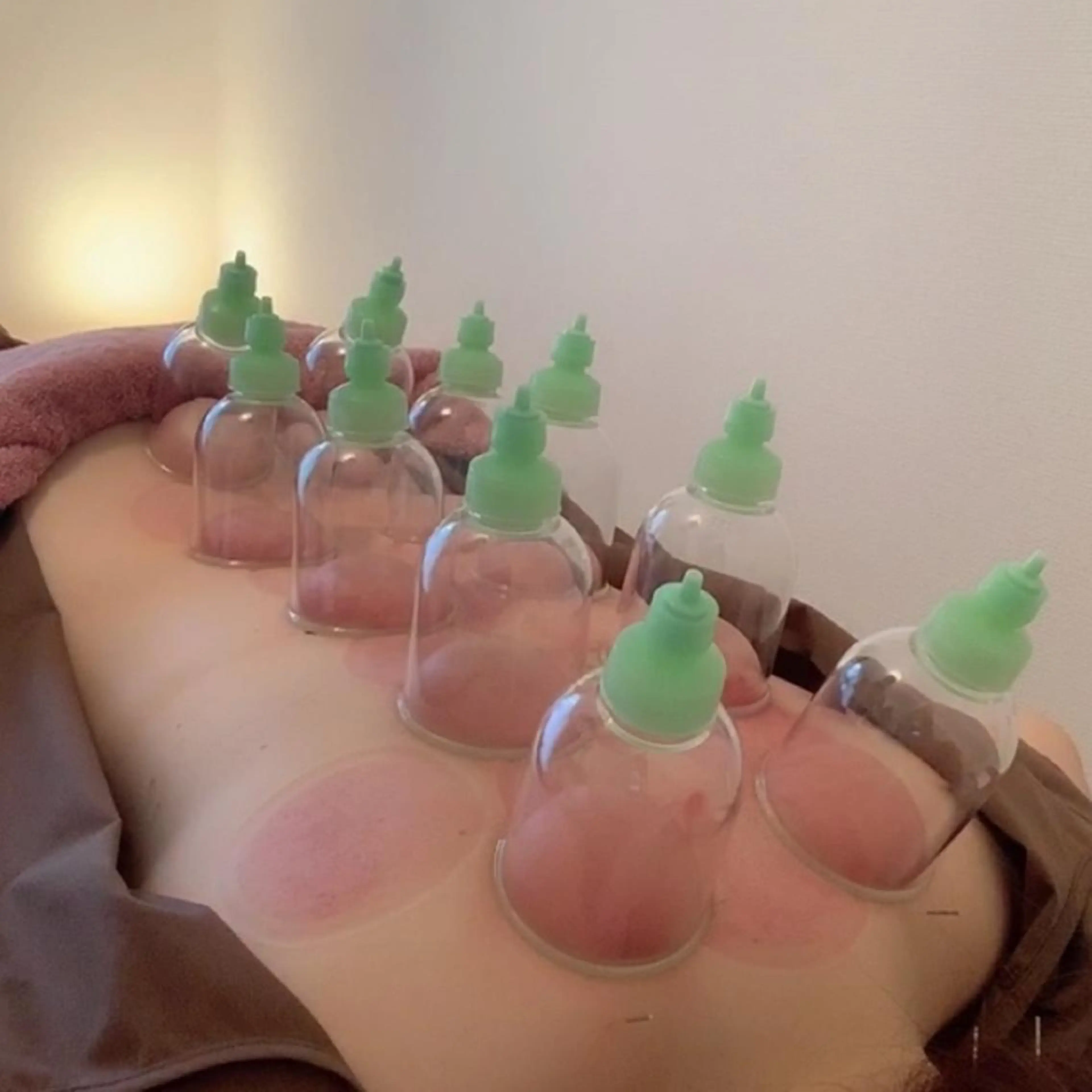 疲労回復😴【美容鍼×頭皮鍼】&カッピング(吸玉)(約60分)の写真