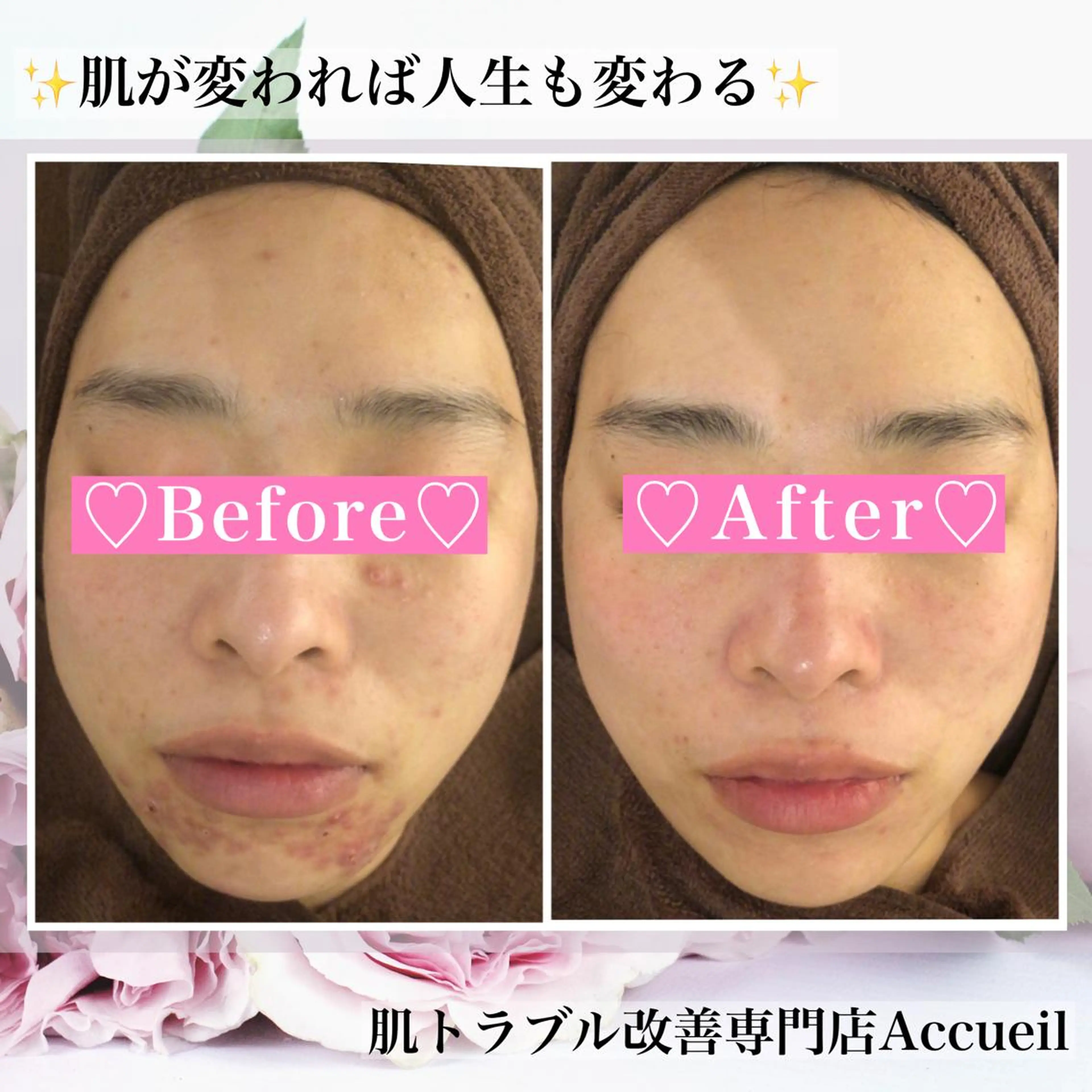 ミディアム カラー パーマ ヘアアレンジ メンズ キッズ ネイル マツエク・マツパ アイブロウ エステ リラク アクール　齋藤 ♡肌トラブル卒業のエステ・リラクイメージ