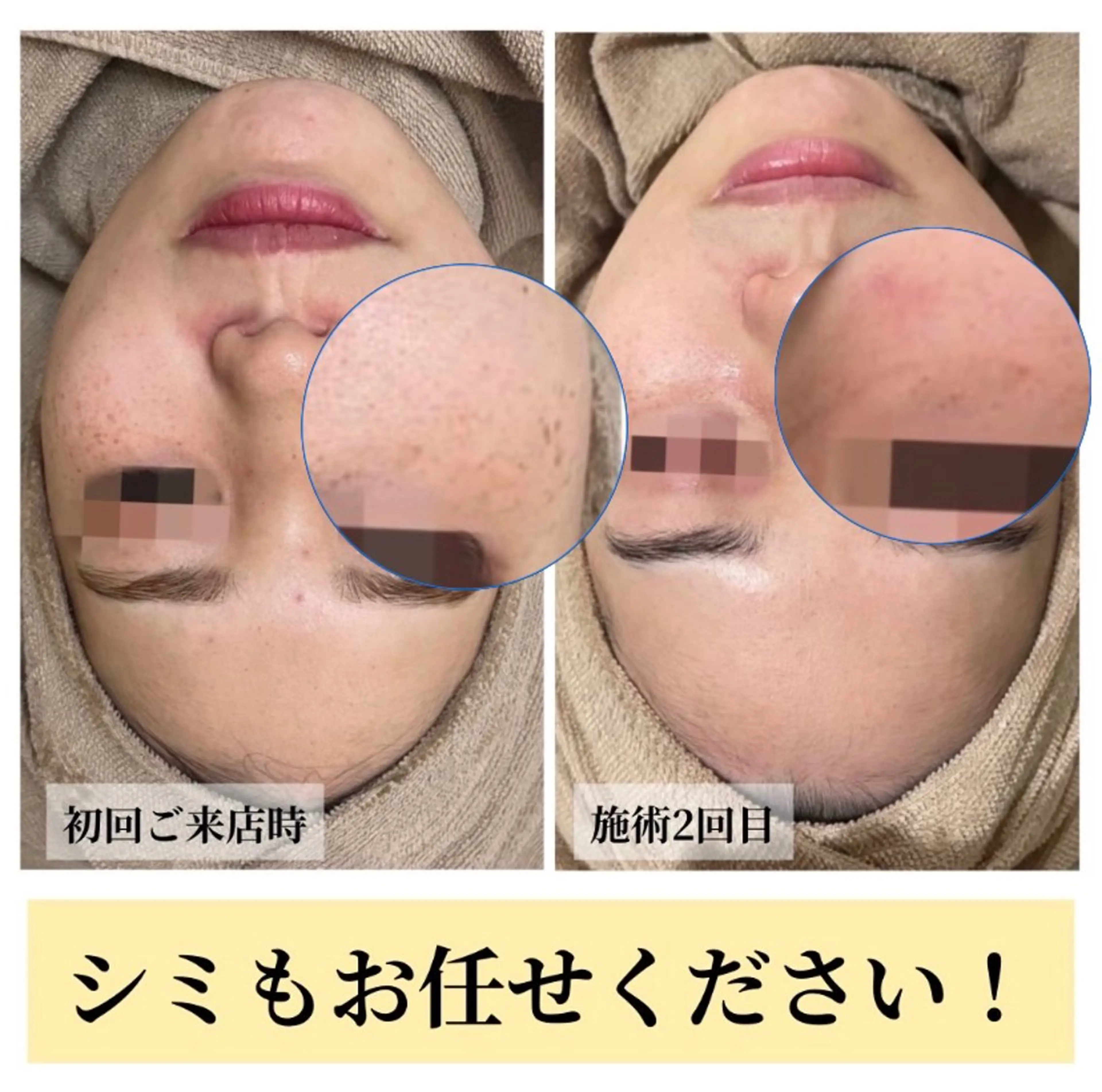 エステ ハーブピーリング・毛穴ケア専門サロンSalon de LENA所属・ハーブピーリング 毛穴専門店/栄のエステ・リラクイメージ