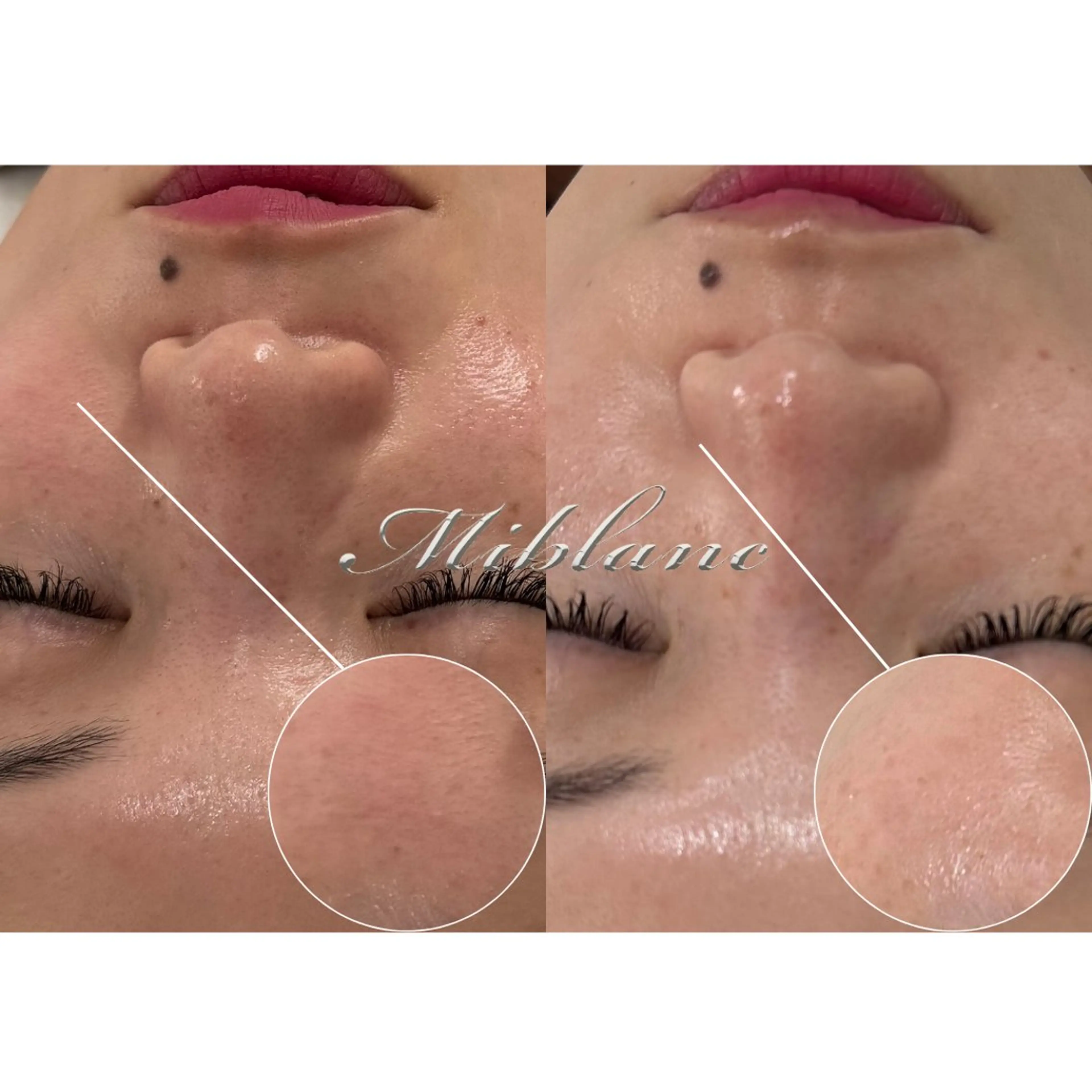 【モニター募集🧖🏻‍♀️】《乾燥にお悩みの方》お肌ダメージ修復ケア ＊1日2名限定＊ 通常価格¥5,800→の写真