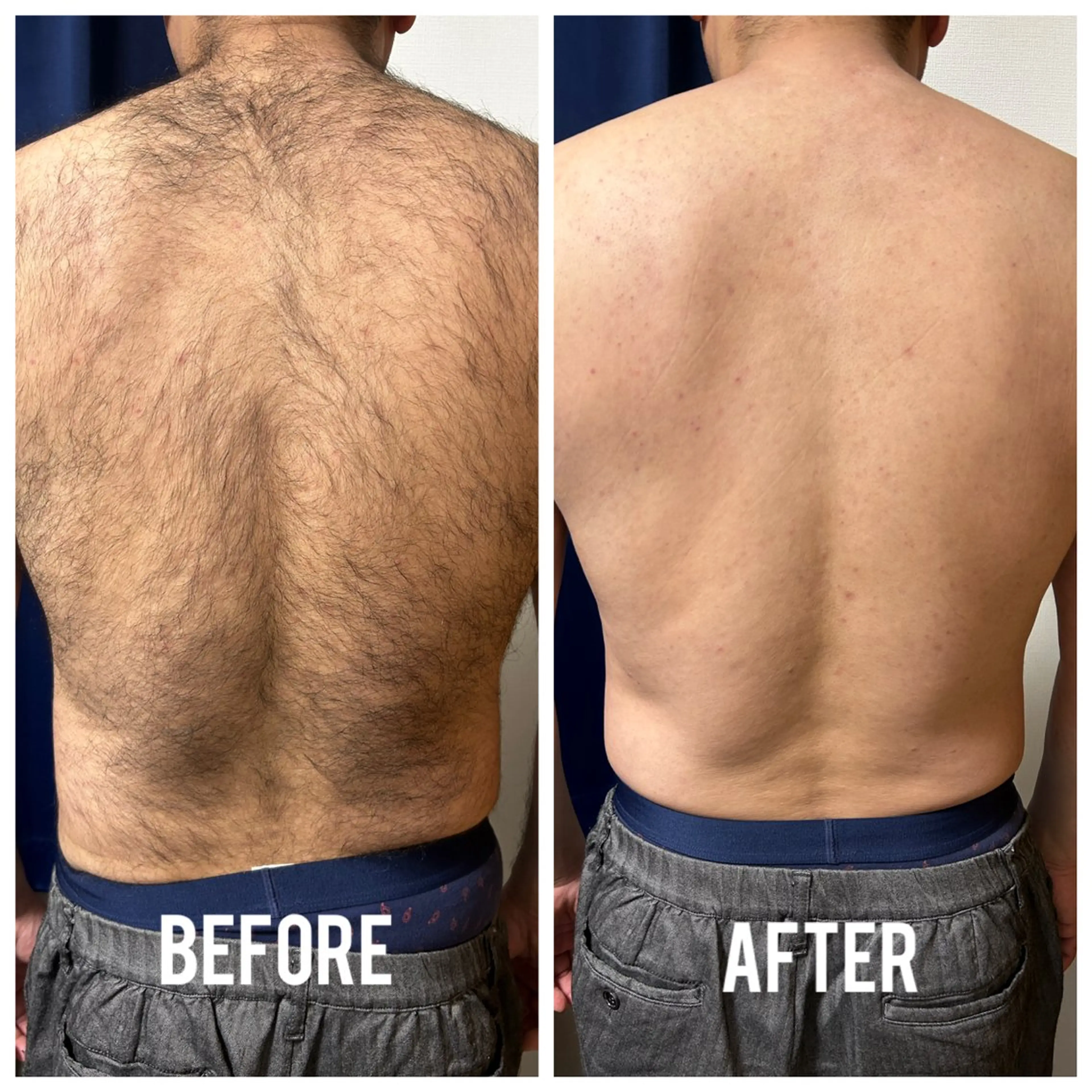 メンズ 脱毛 メンズ脱毛サロン shavys所属・shavys せいじのエステ・リラクイメージ