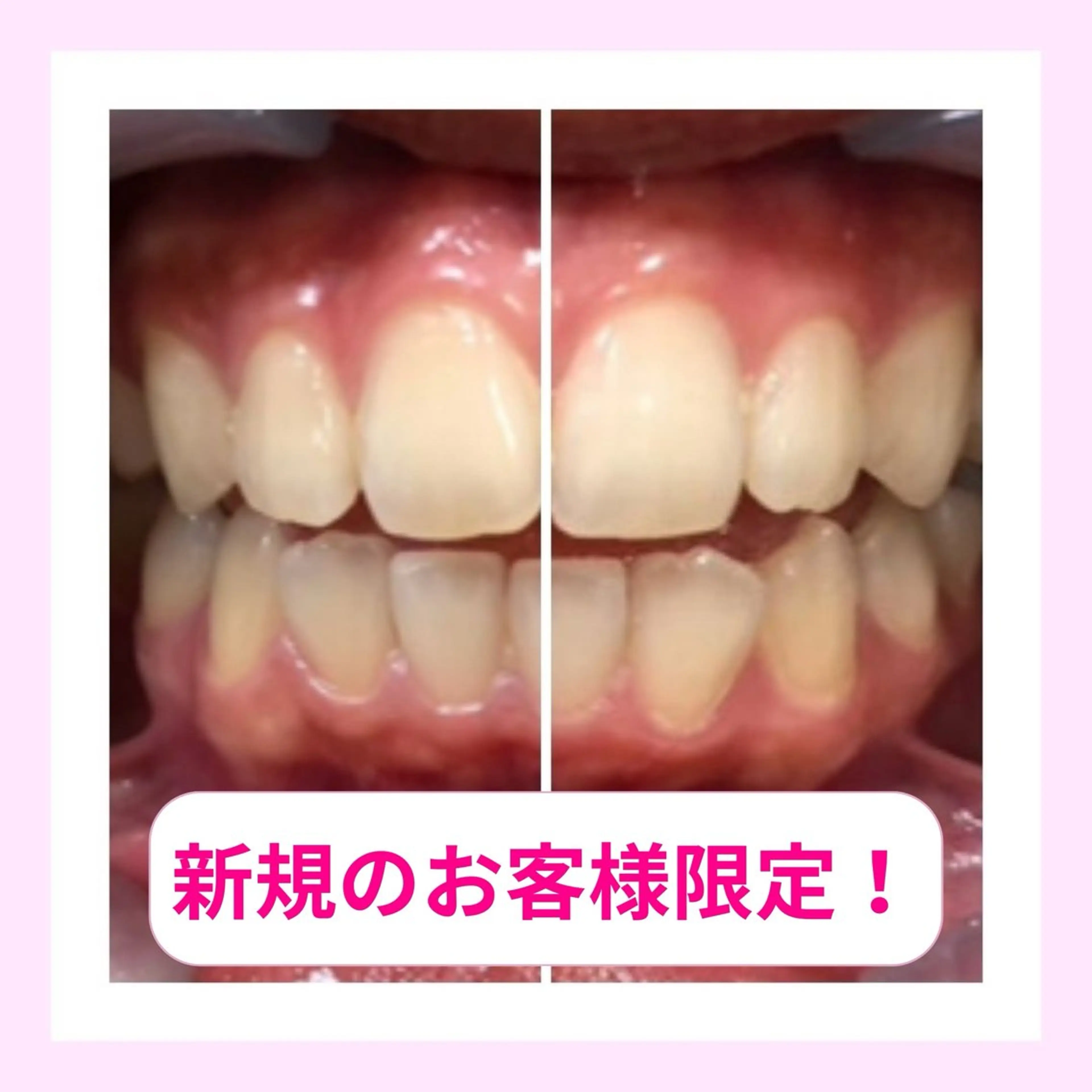 【U24限定】可愛いは歯から！超簡単ホワイトニング◎お試しメニューの写真