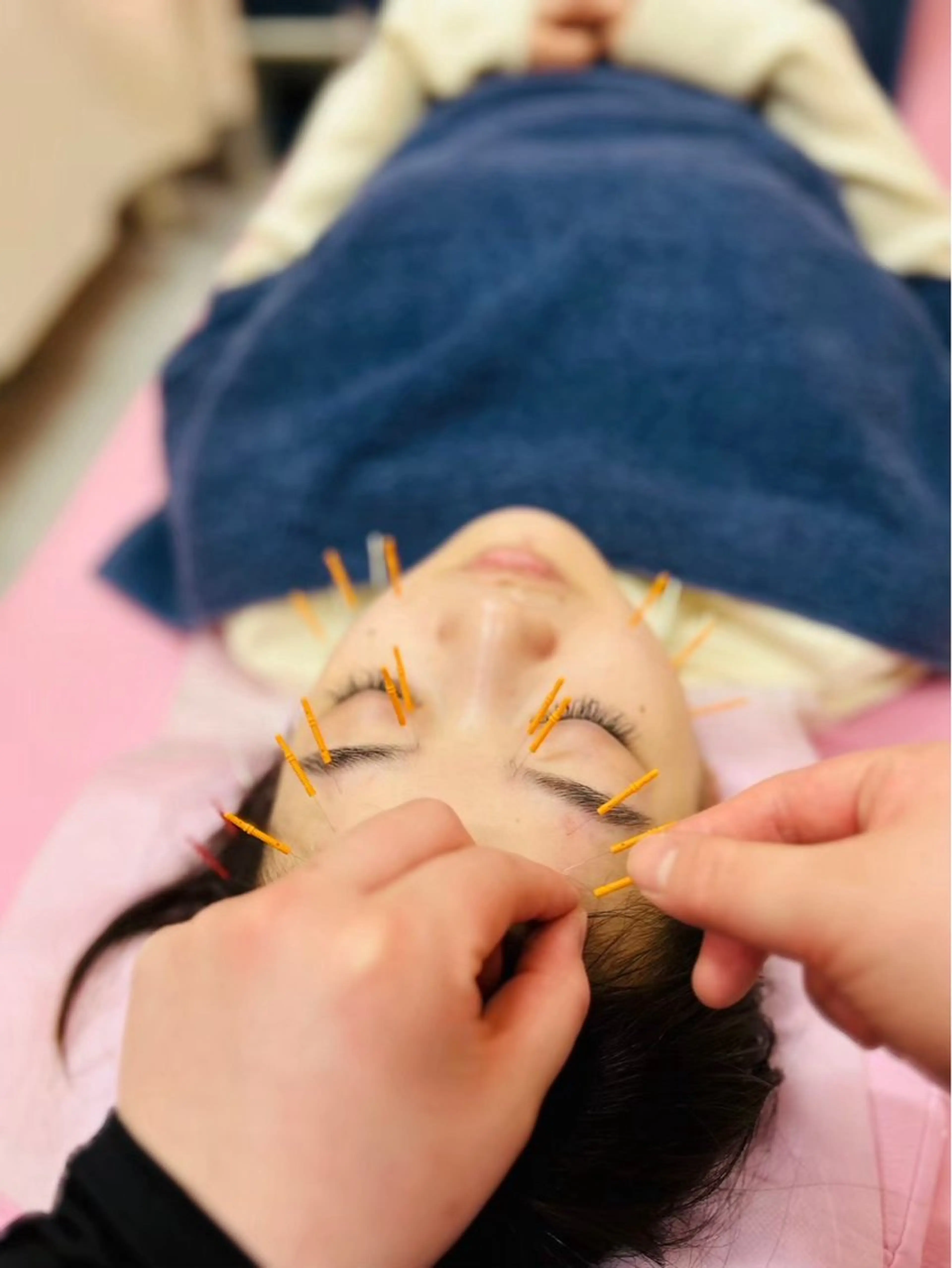 【大人気◎電気美容鍼】小顔/むくみ/シミ/肌荒れニキビケア5850円→3000円の写真