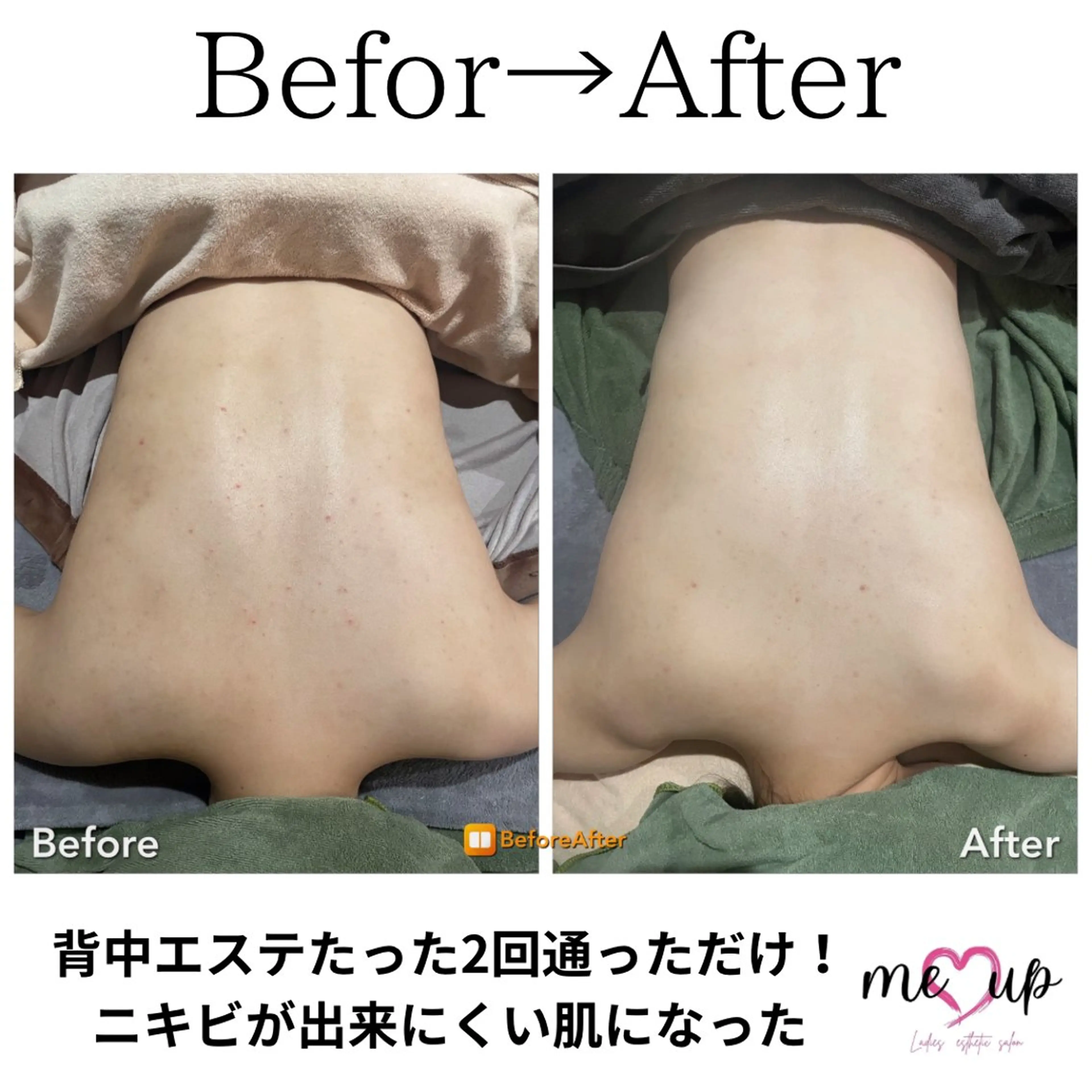 エステ Meupニキビ専門店 背中/ハーブ/ララのその他イメージ