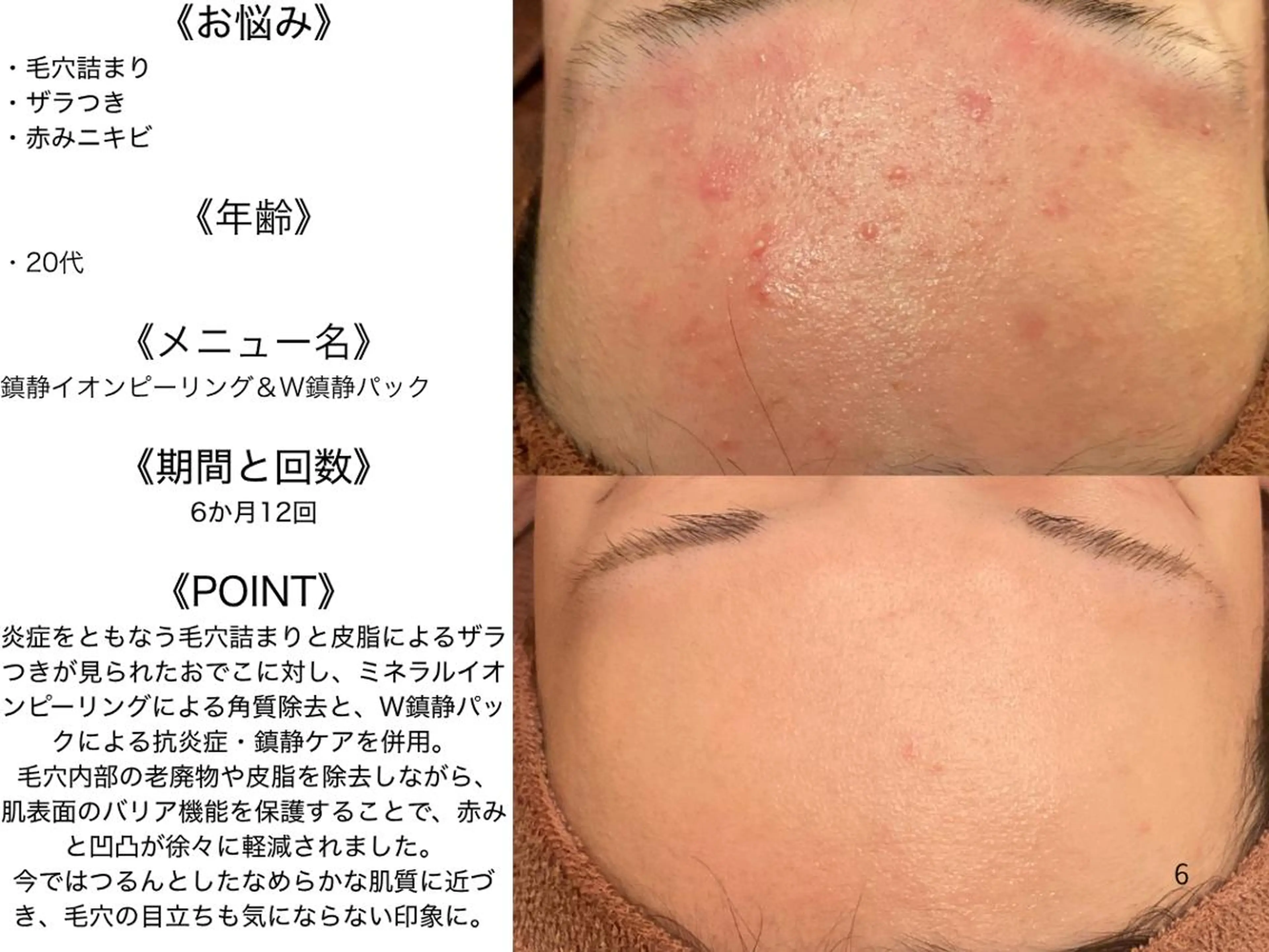 エステ リラク ニキビ特化型エステ 🍋最短で肌質改善のエステ・リラクイメージ
