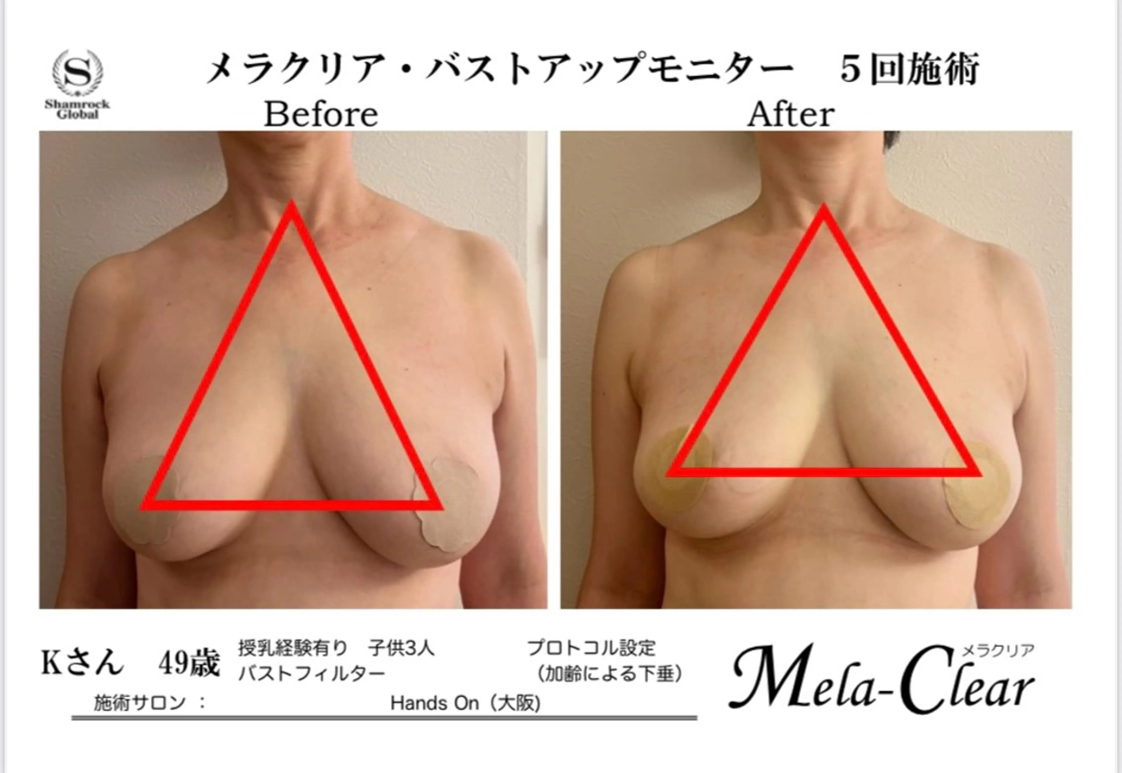 光美容シャムロック バスト、シミ専門店のエステ・リラクイメージ