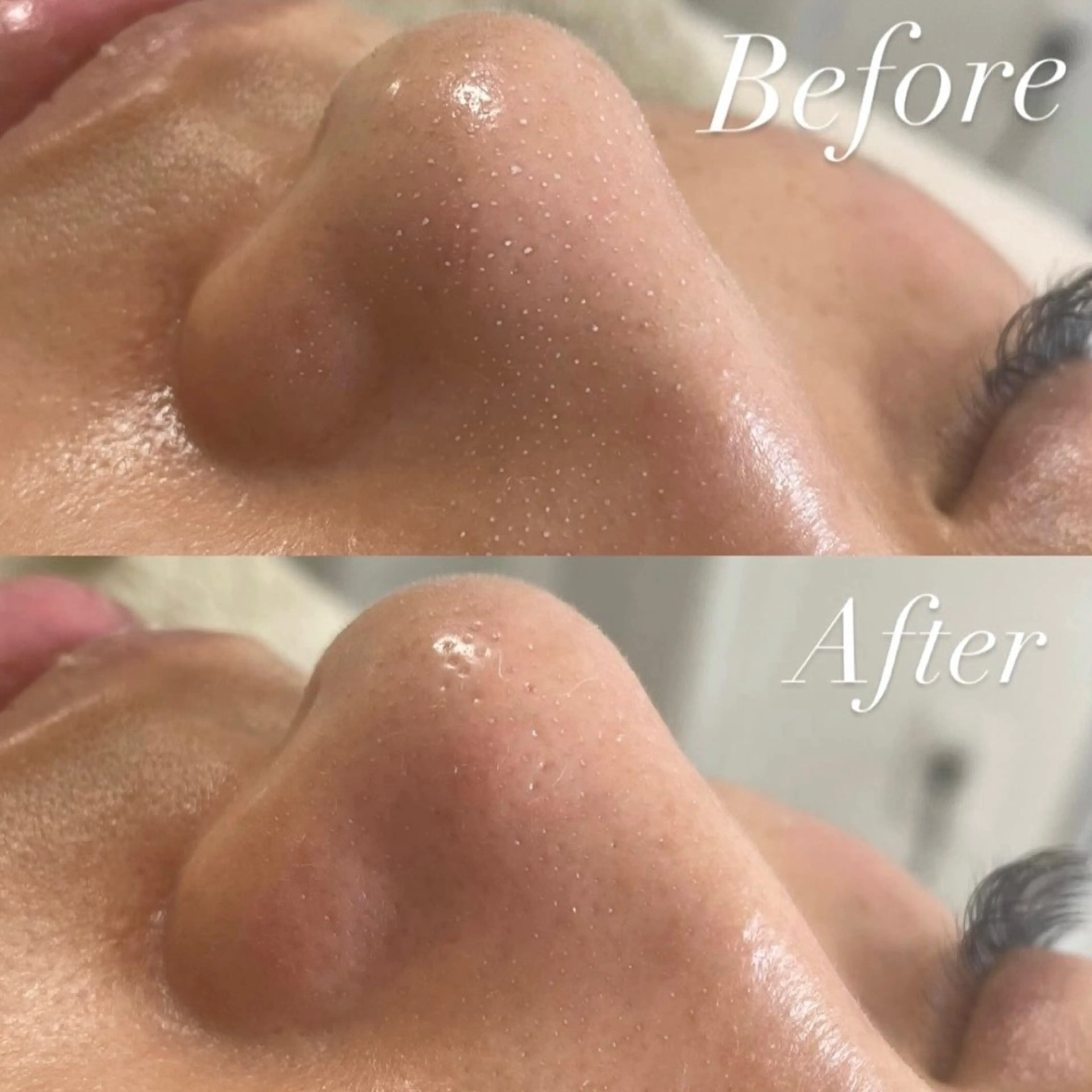【鼻に集中ケア💖👃】鼻だけ水素ハイドラ🫧の写真