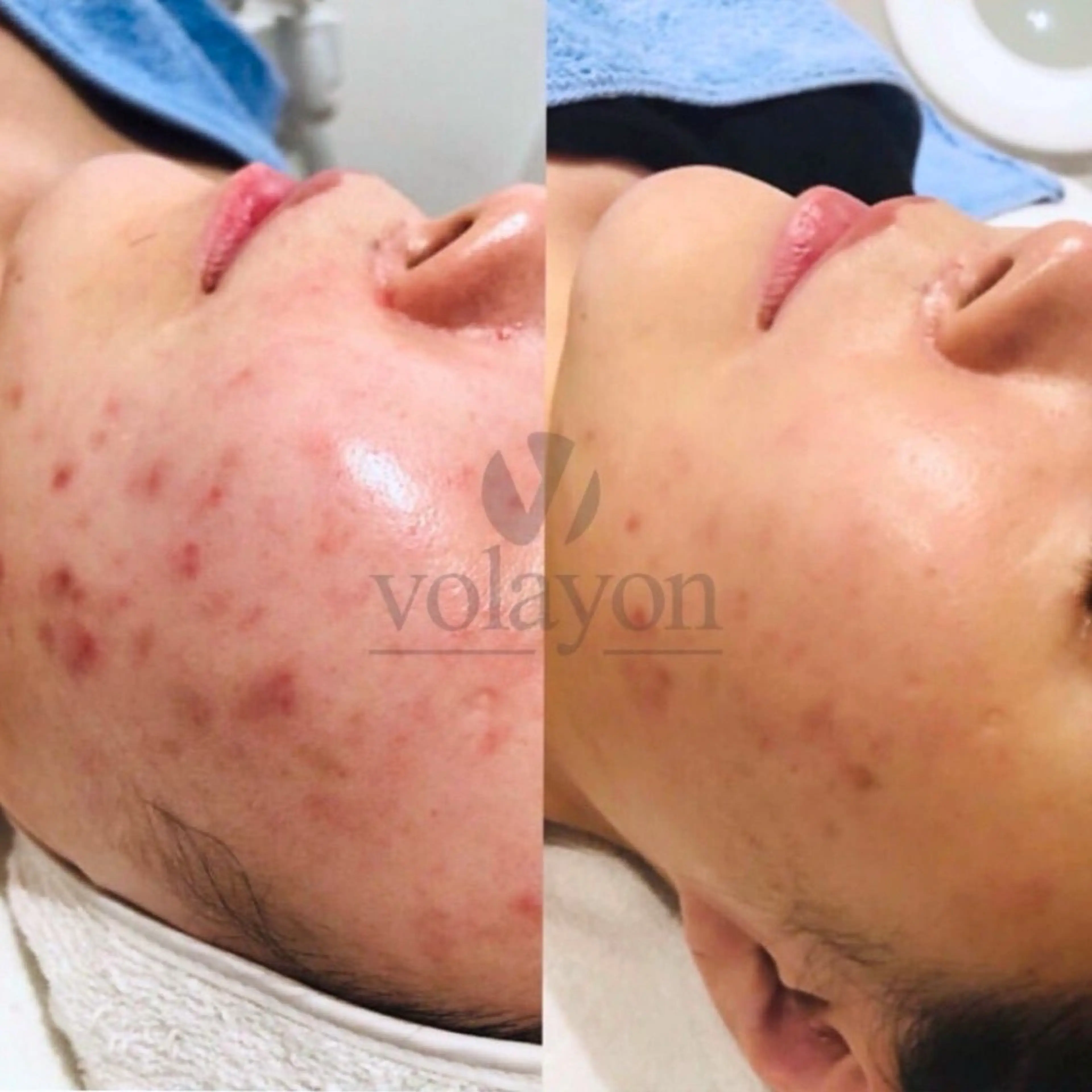 【オイリー脂性肌/毛穴管理】皮脂やニキビケアに悩まない澄んだクリアな素肌へ◎アクアピール+アンチプレシオネス管理の写真