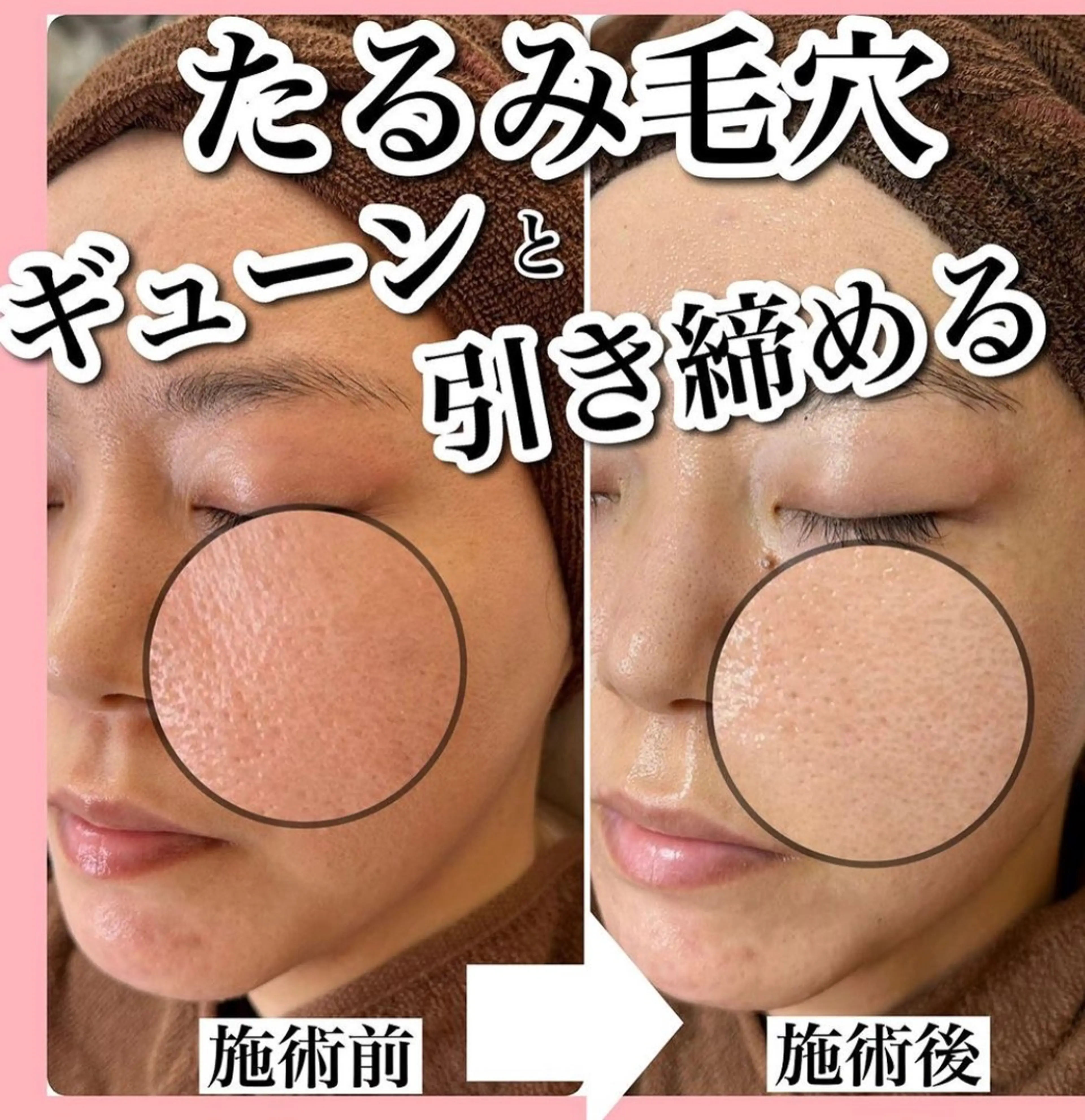 REVI陶肌トリートメント(次世代ハーブピーリング)の ビフォー