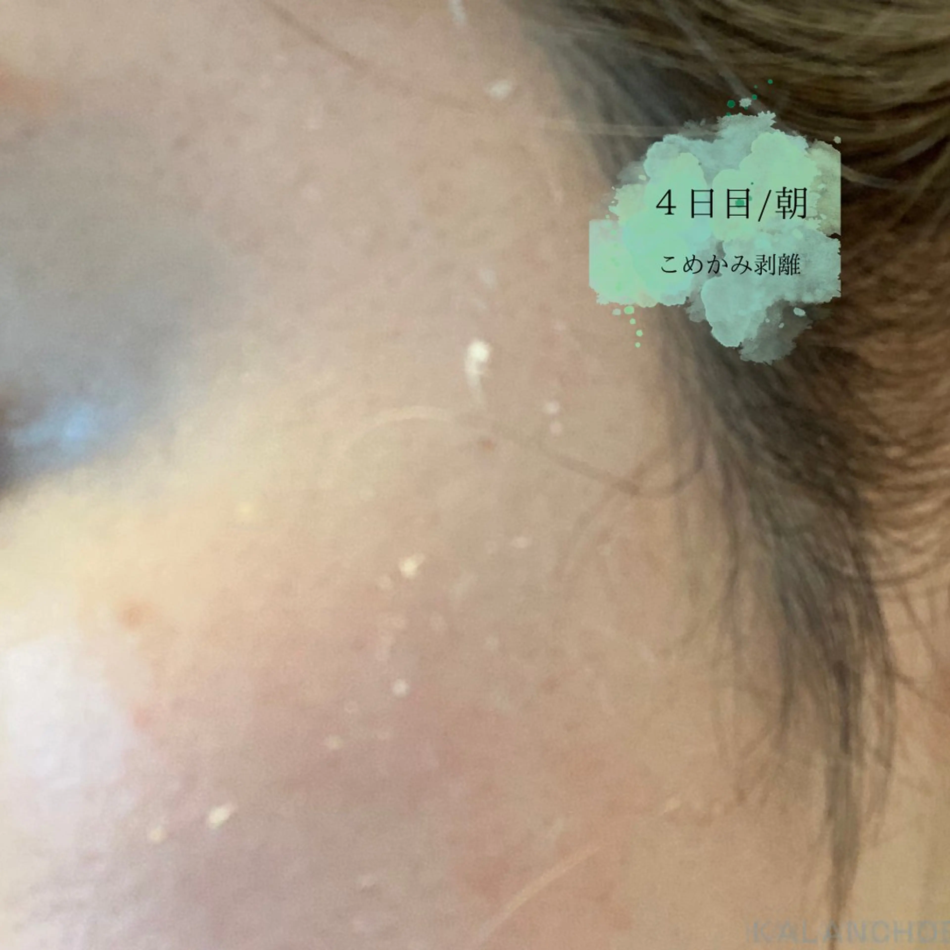 エステ 肌質改善 KALANCHOEのエステ・リラクイメージ