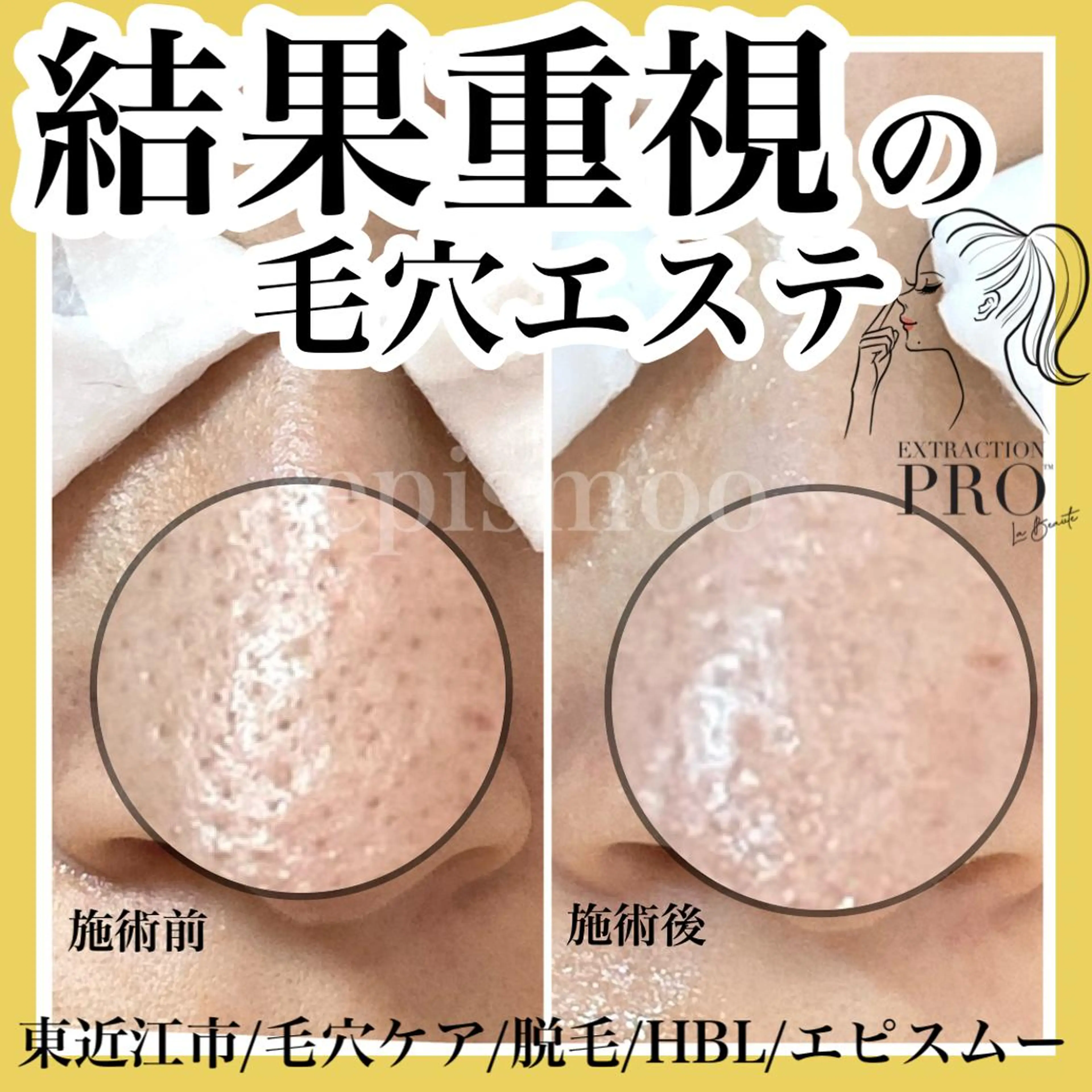 epismoo 脱毛/HBL/毛穴の眉毛・アイブロウイメージ