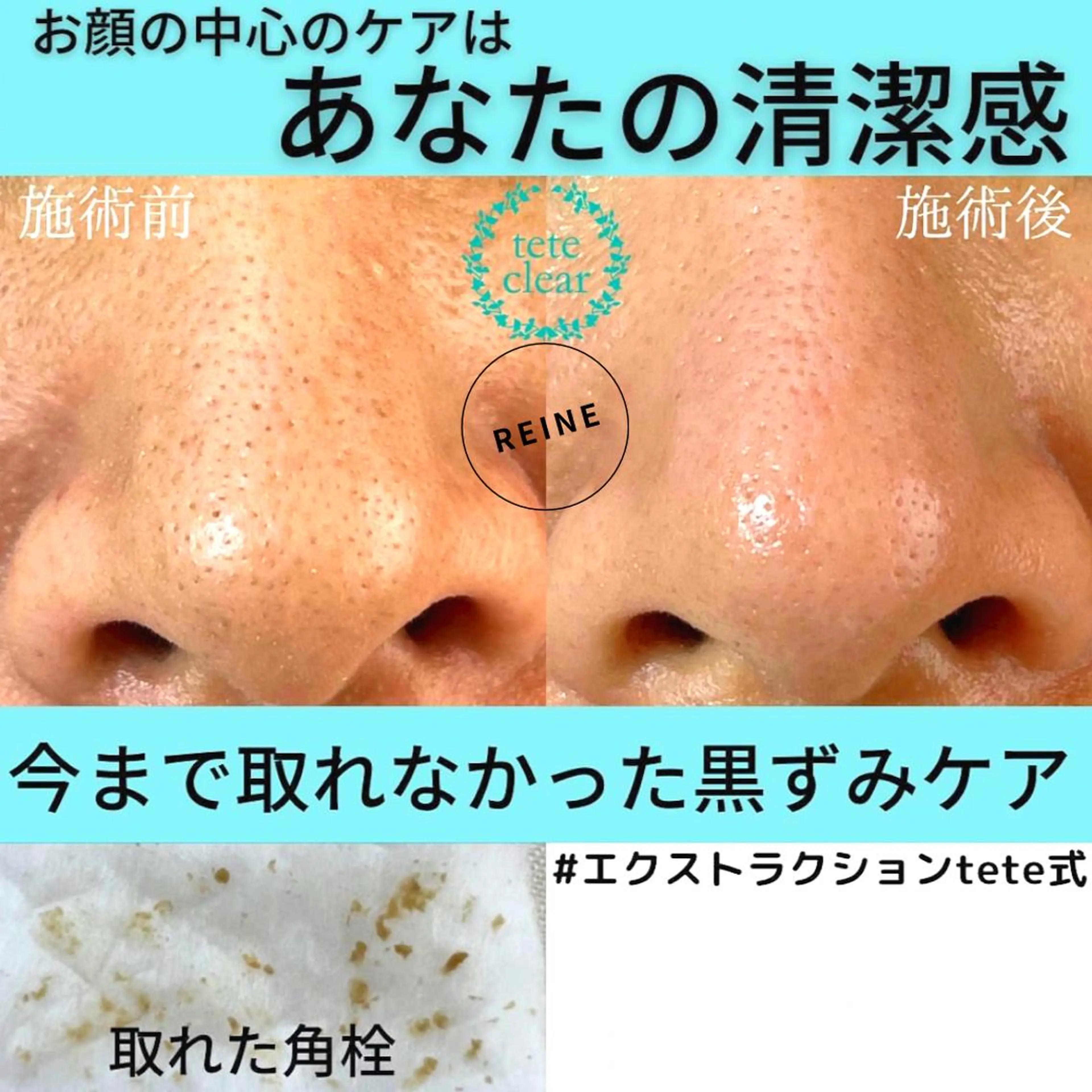 エステ Reine BeautySalon所属・毛穴/シミ肝斑/脱毛 横山梨里のエステ・リラクイメージ