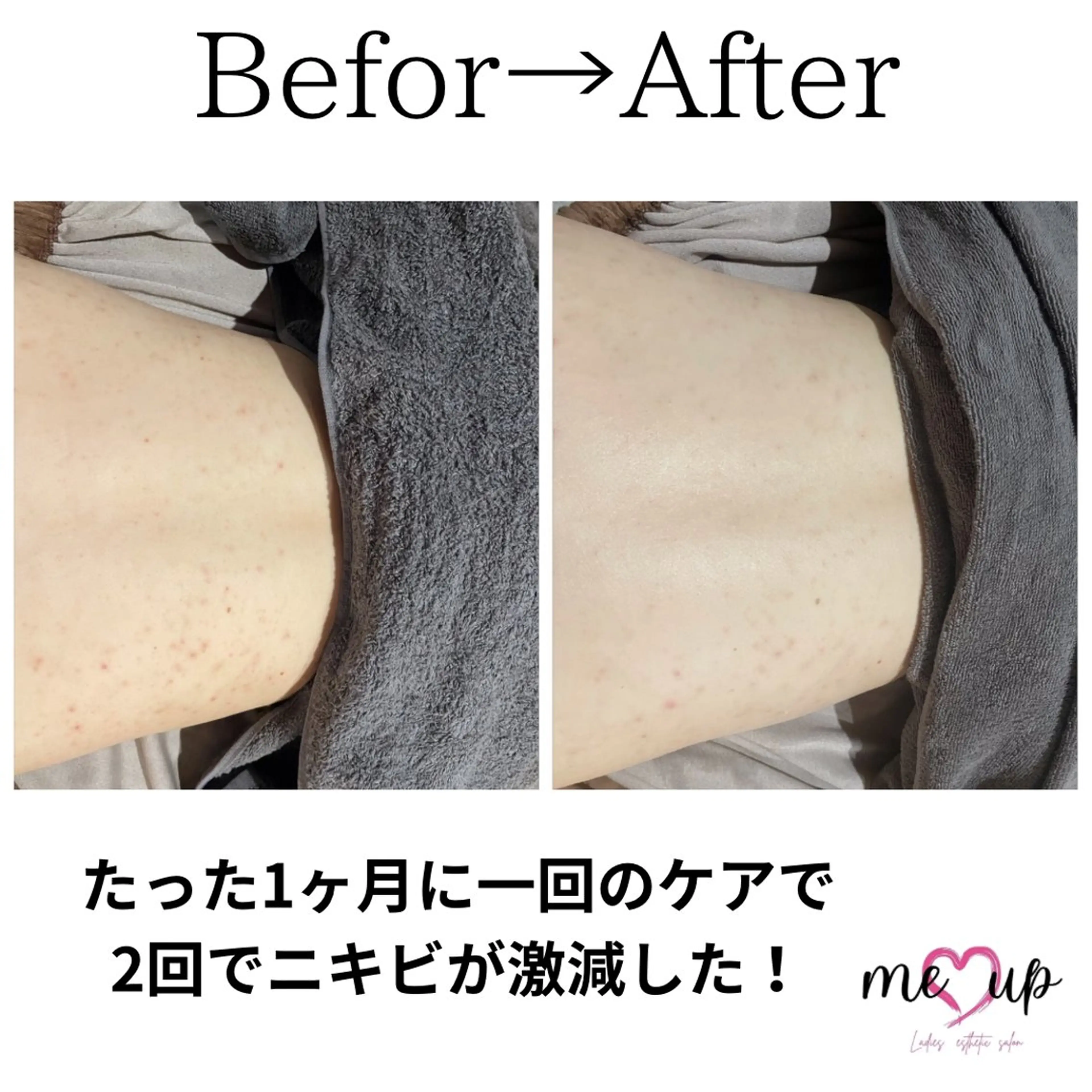 エステ Meupニキビ専門店 背中/ハーブ/ララのその他イメージ