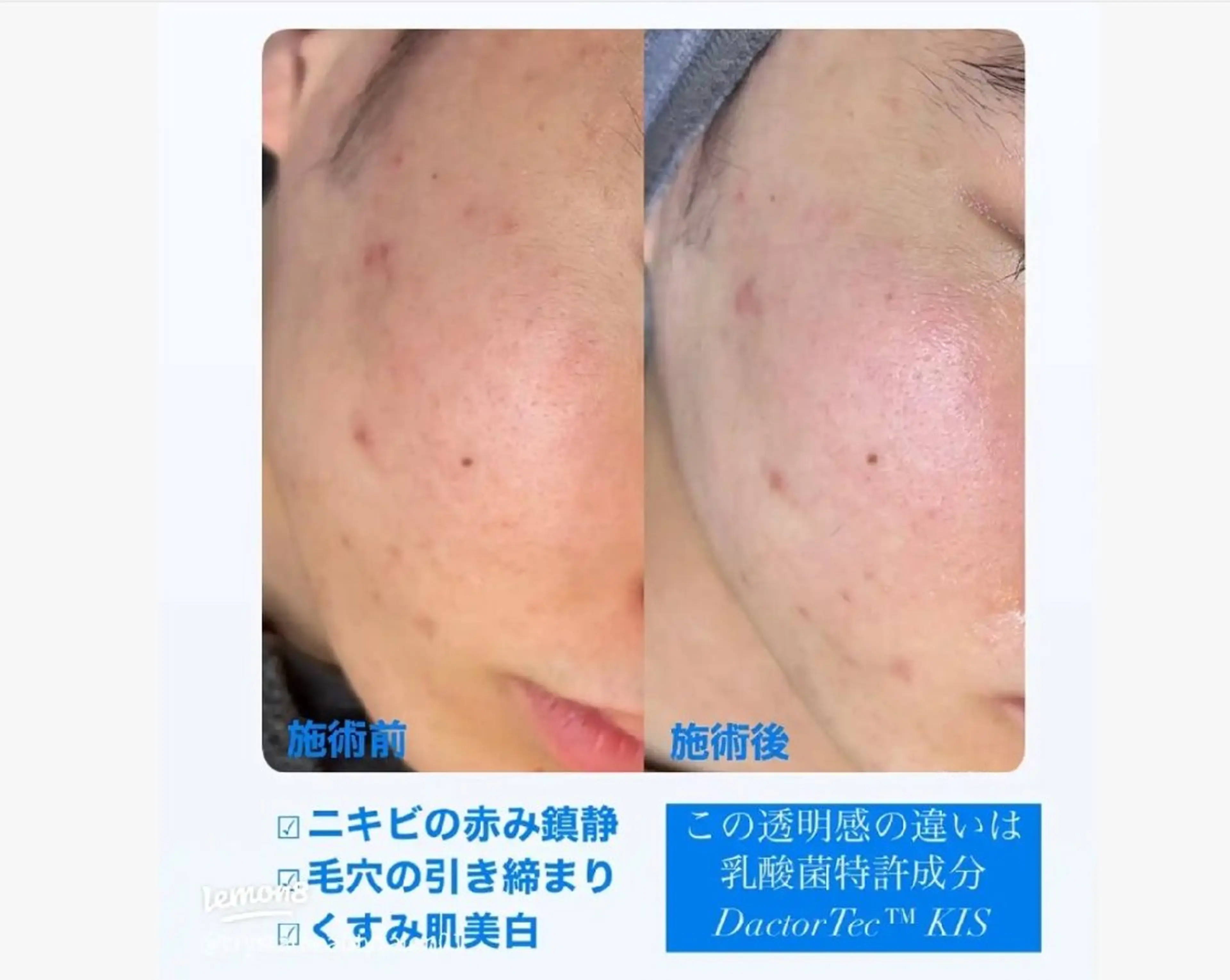 ハイドラフェイシャル+セラピール【水光肌】30代以降のお肌にハリとツヤ!ニキビ、美肌ケアにも✨️の写真