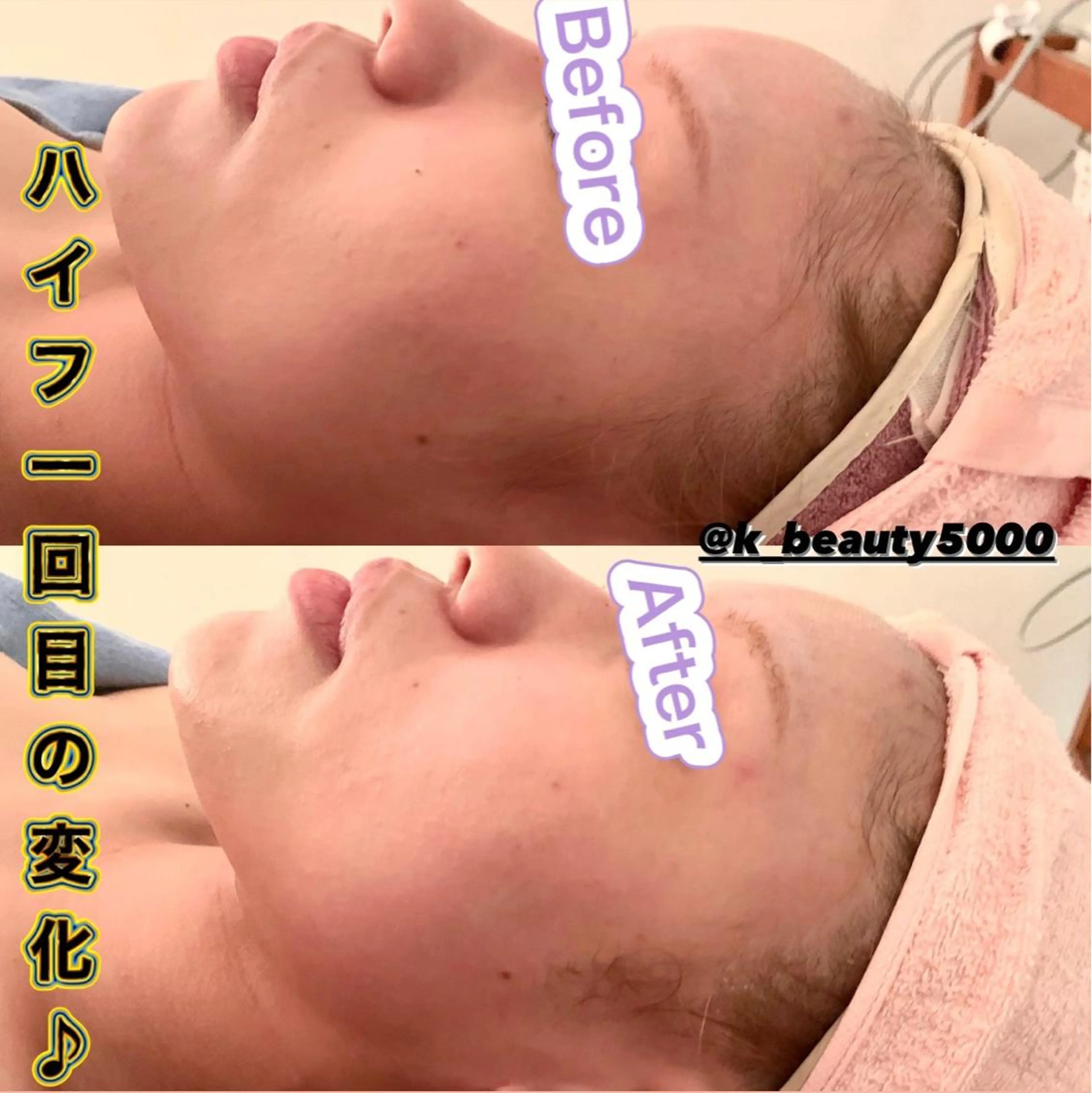 【ハイパーナイフ痩身&小顔コルギ&ハーブピーリング】K-Beauty　東新宿所属・kーbeauty小顔 コルギ&インディバのエステ・リラクイメージ
