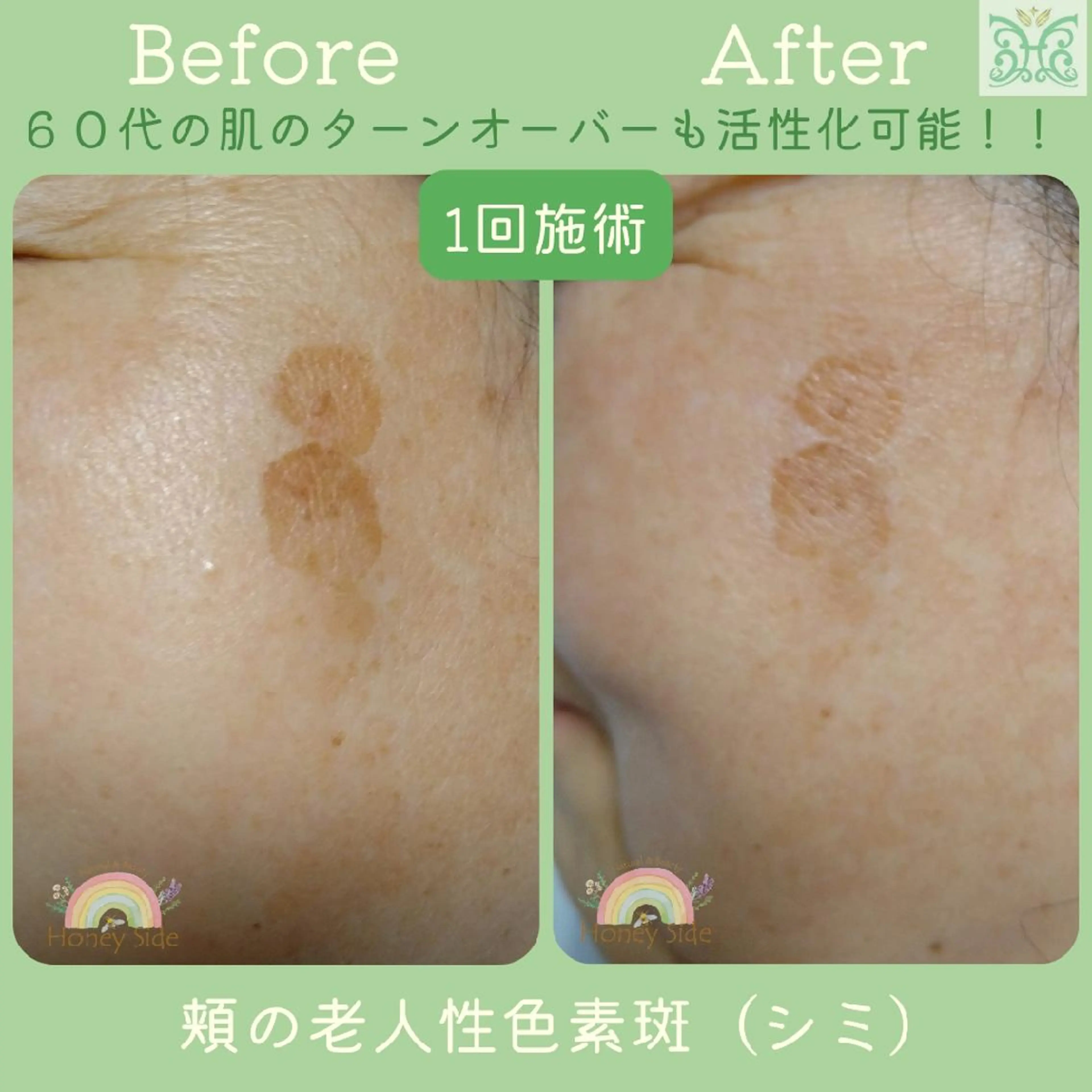 剥離するハーブ🌈 Honey Sideのエステ・リラクイメージ