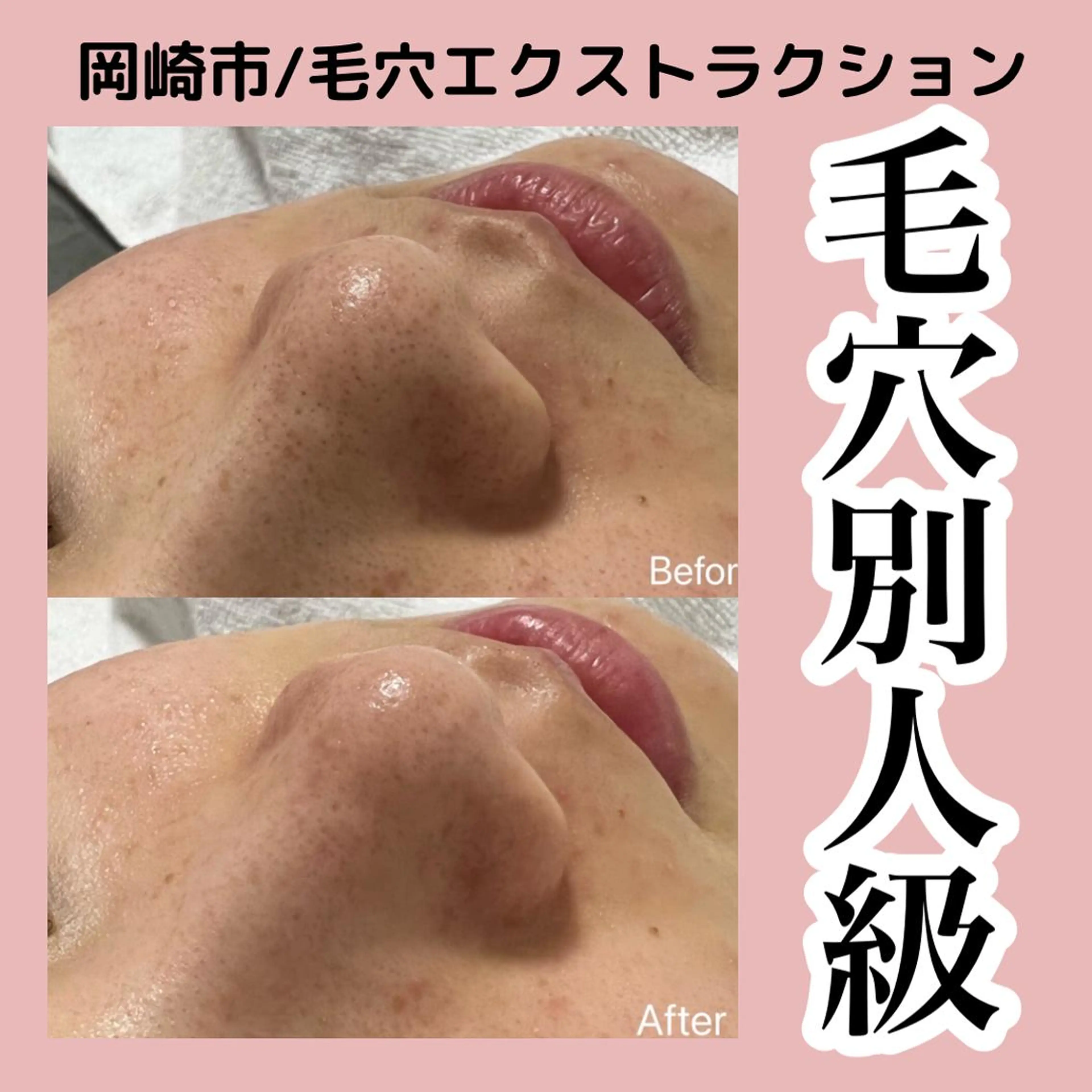 エステ ■超絶小顔＆肌管理室■所属・🦋整形級の究極美顔 本格韓国式小顔🦋のエステ・リラクイメージ