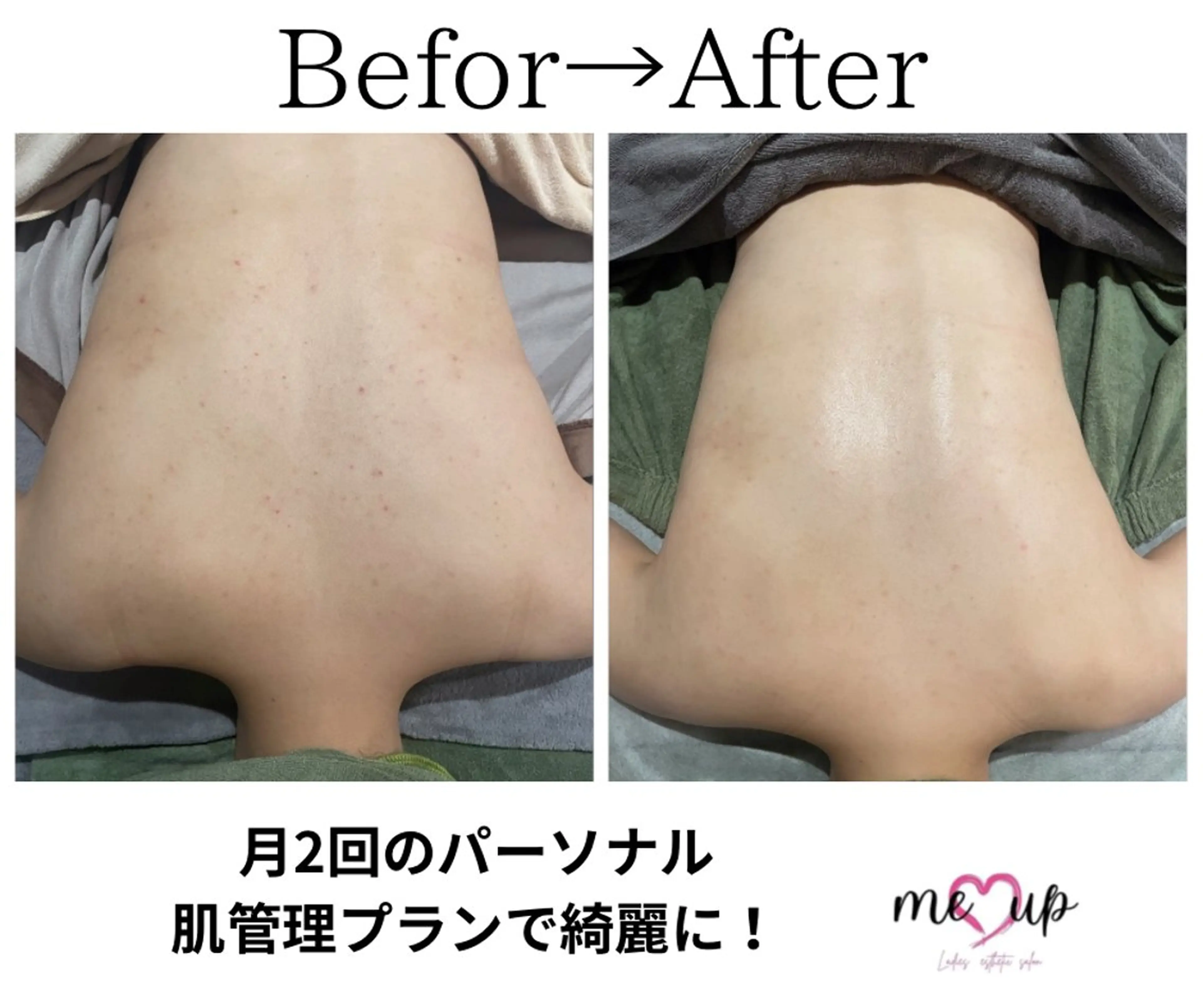 エステ Meupニキビ専門店 背中/ハーブ/ララのその他イメージ