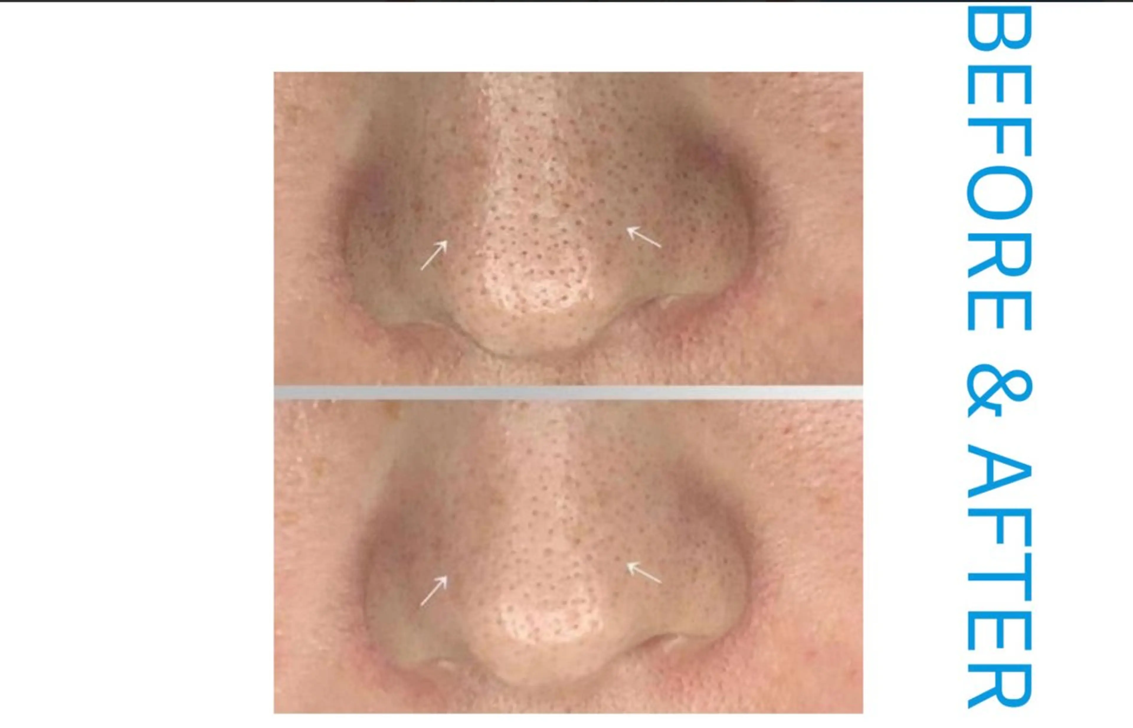 【濃厚美容成分】毛穴洗浄×リフトアップパックコースの写真