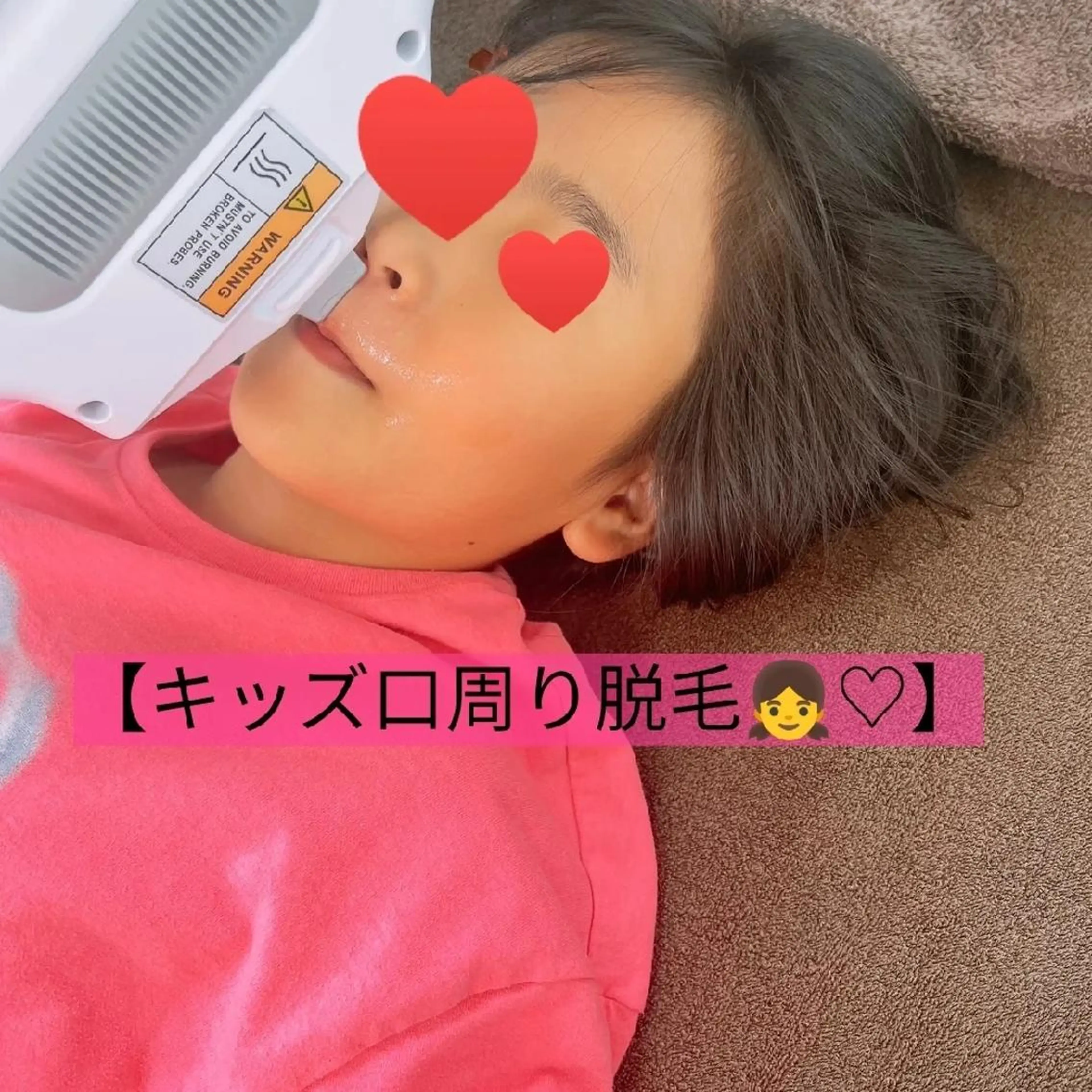 キッズ脱毛※9歳​〜​中3まで👧手足、ワキ、眉間、口周りセットの写真