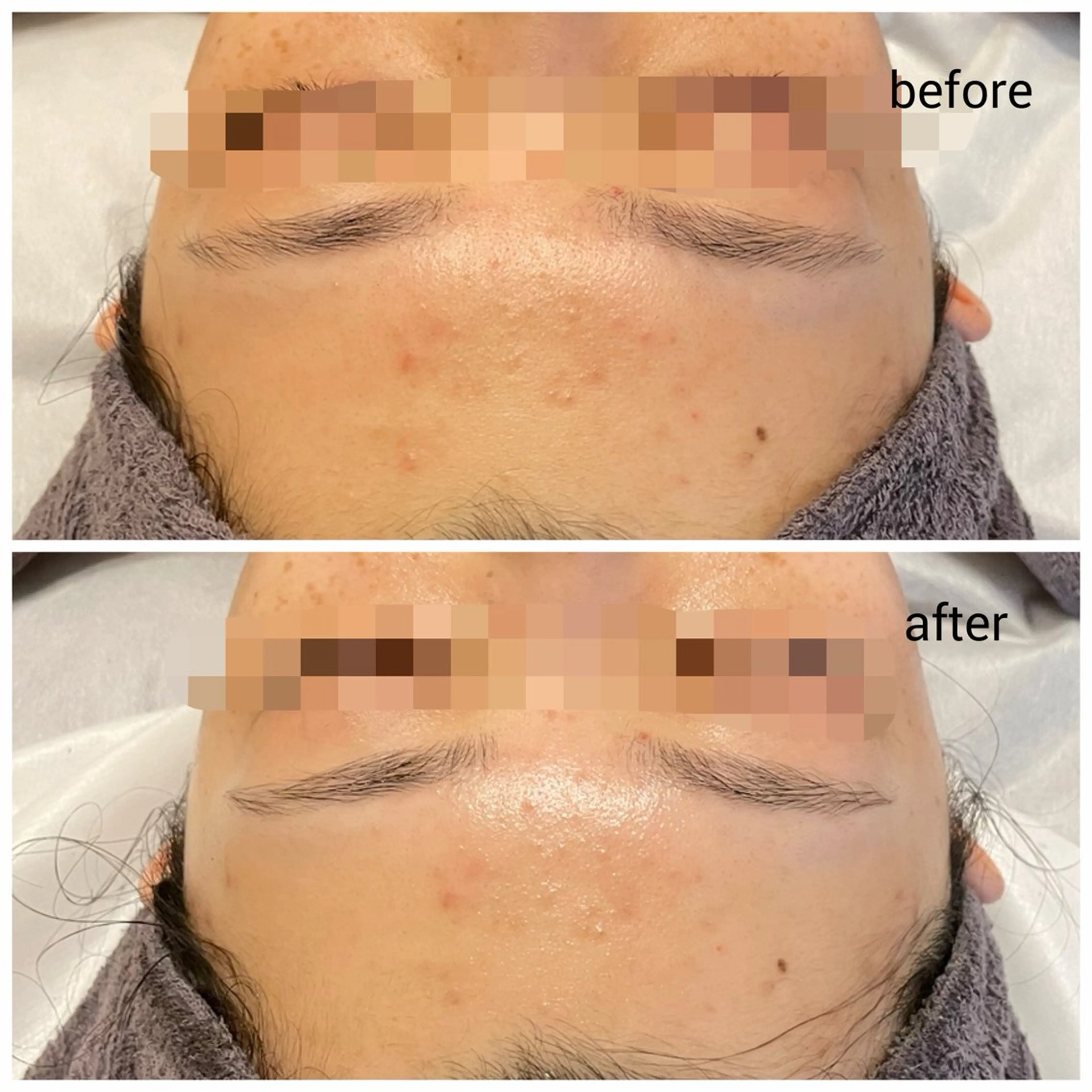 メンズ エステ 毛穴改善ハーブピーリングMinouミヌ心斎橋所属・ミヌ心斎橋 あやめのエステ・リラクイメージ