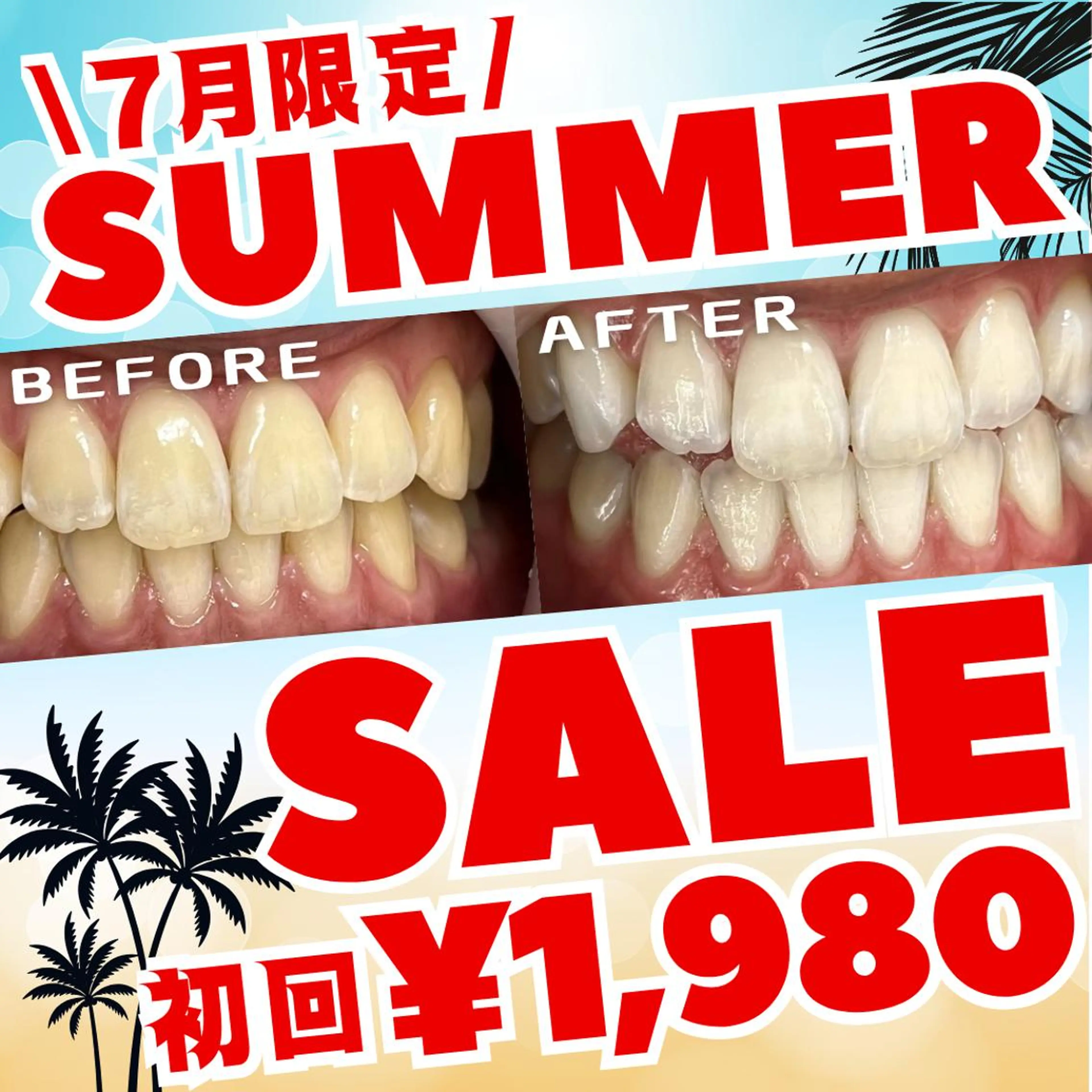 【7月限定🌺サマーセール🉐】8分照射×2回のお手軽セルフホワイトニング💎この夏、白い歯で輝く笑顔に🦷🌞の写真