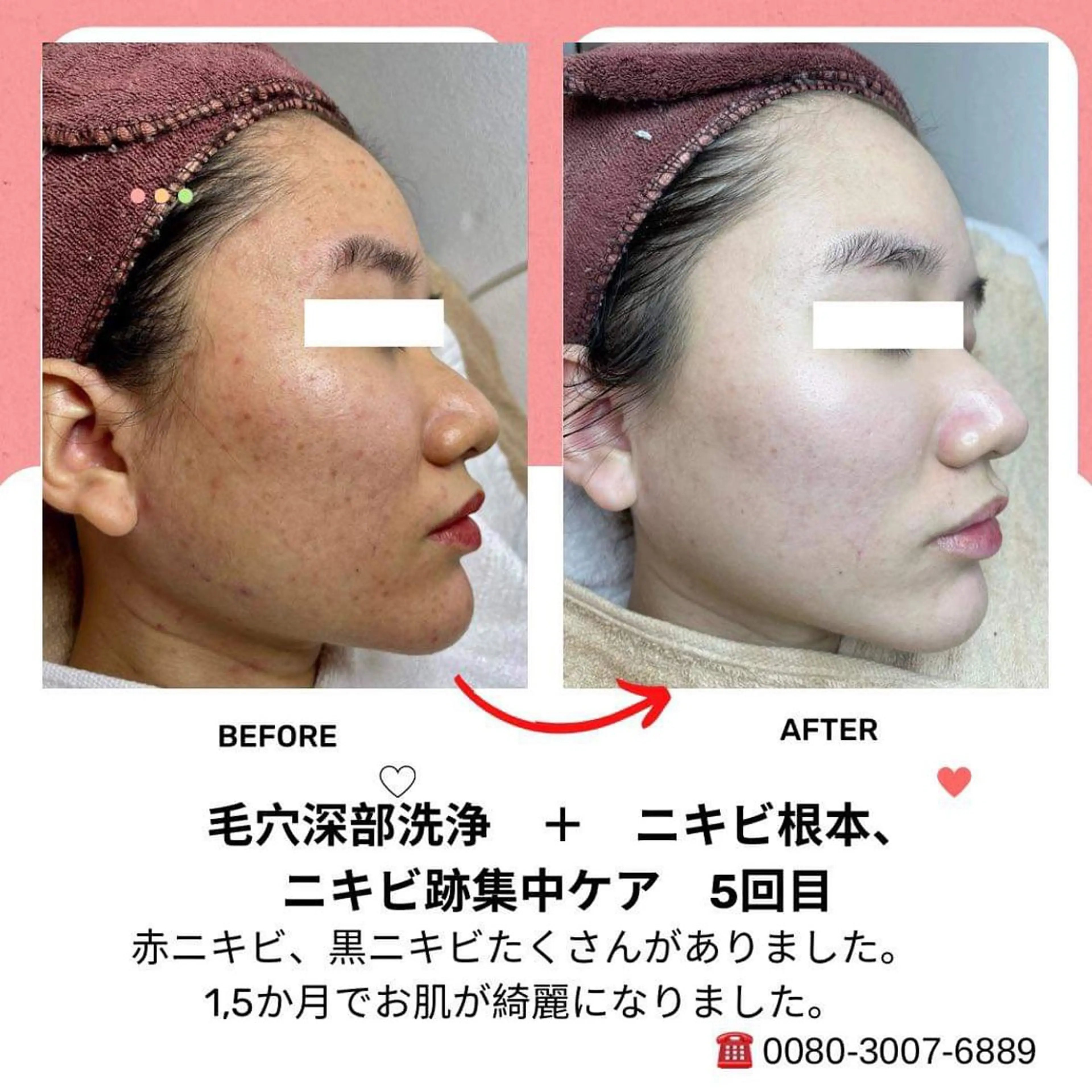 ニキビ、痩身、脱毛、 サクラチャンスパのエステ・リラクイメージ