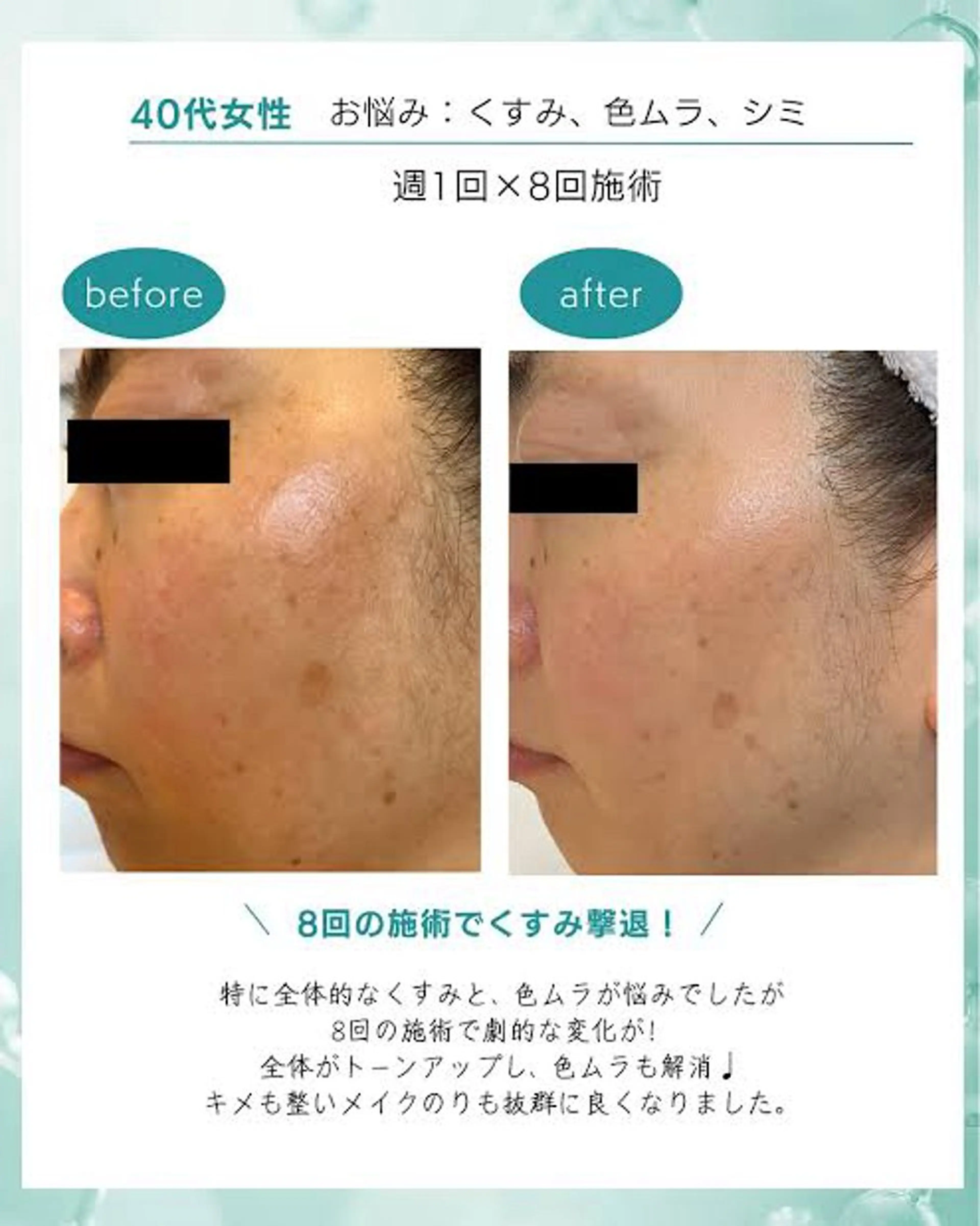 【フェイシャル人気Ｎｏ．1✨️】水光白玉フェイシャル 100分🫧の写真