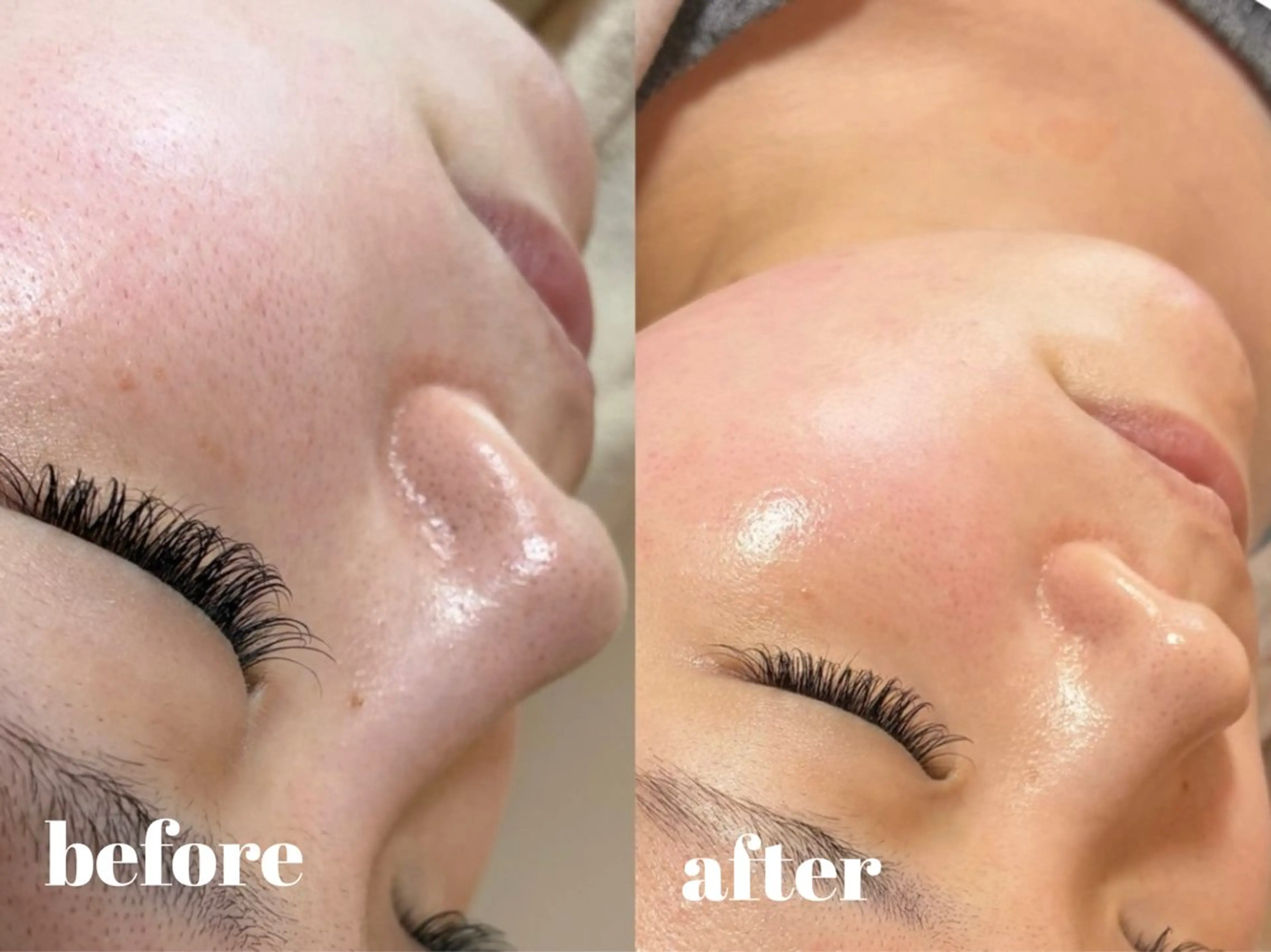 【人気No.1】透明感UP!フェイスワックス+ハイドロジェリーマスクの写真