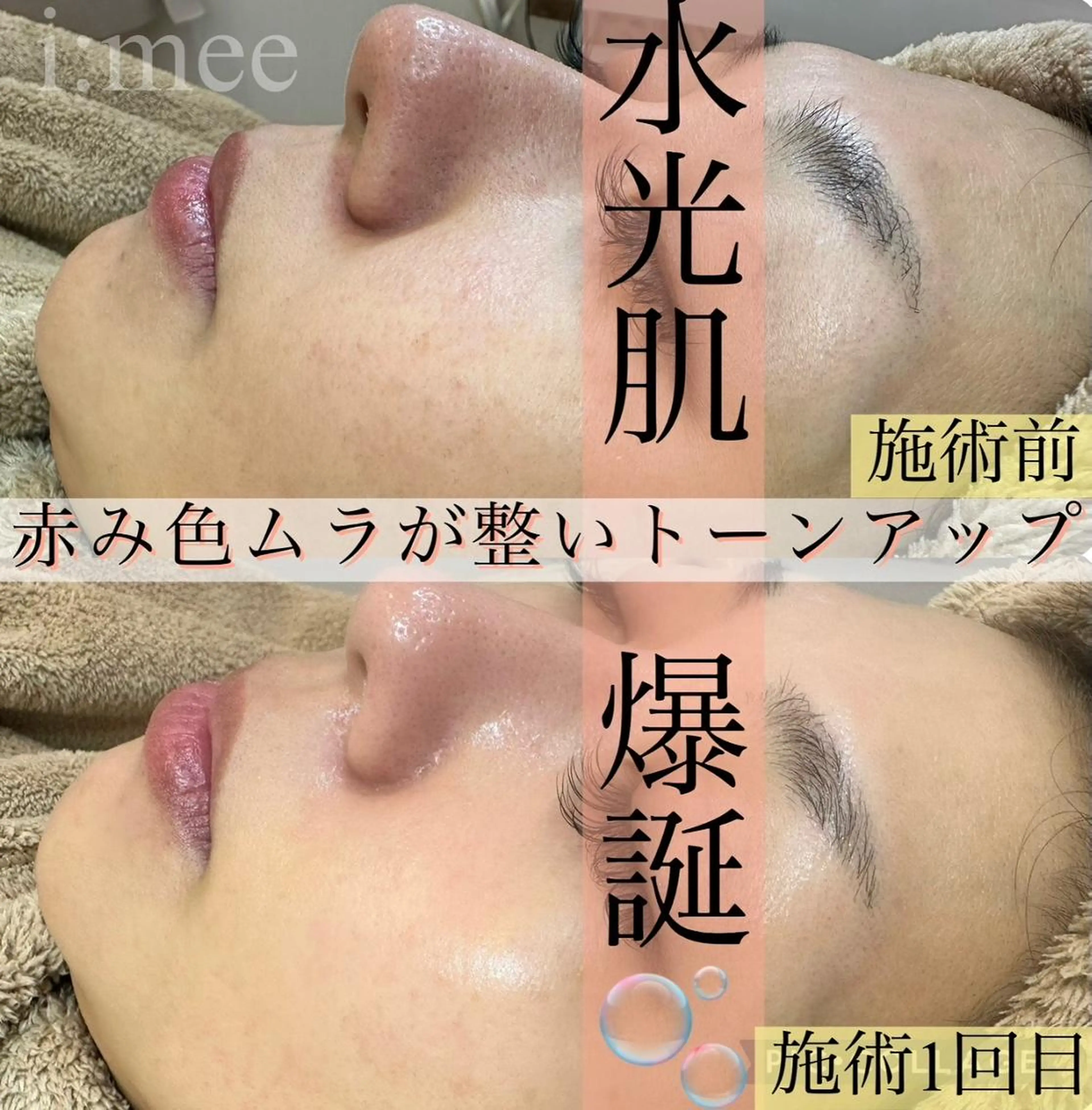 ハイドラ+スノーピーリングの写真